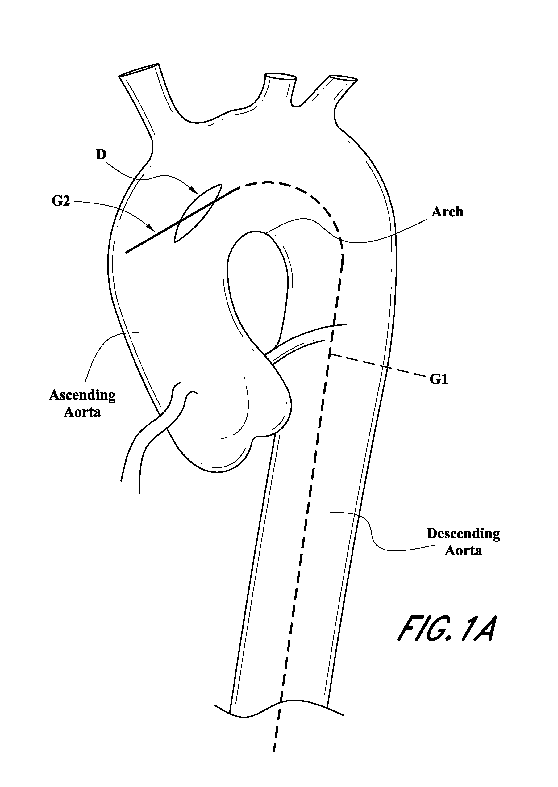 Vascular graft device placement system and method