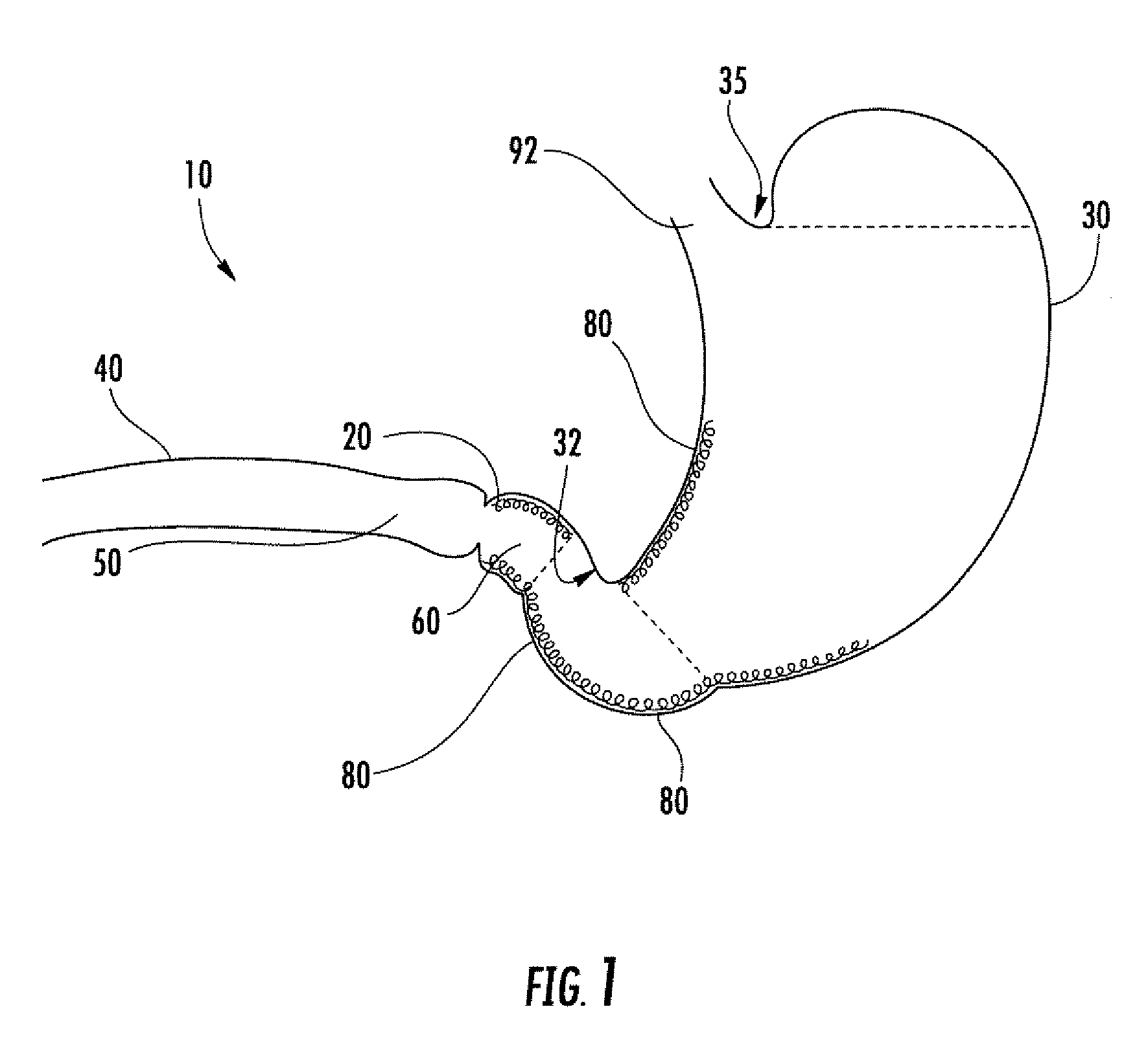 Pyloric valve devices and methods
