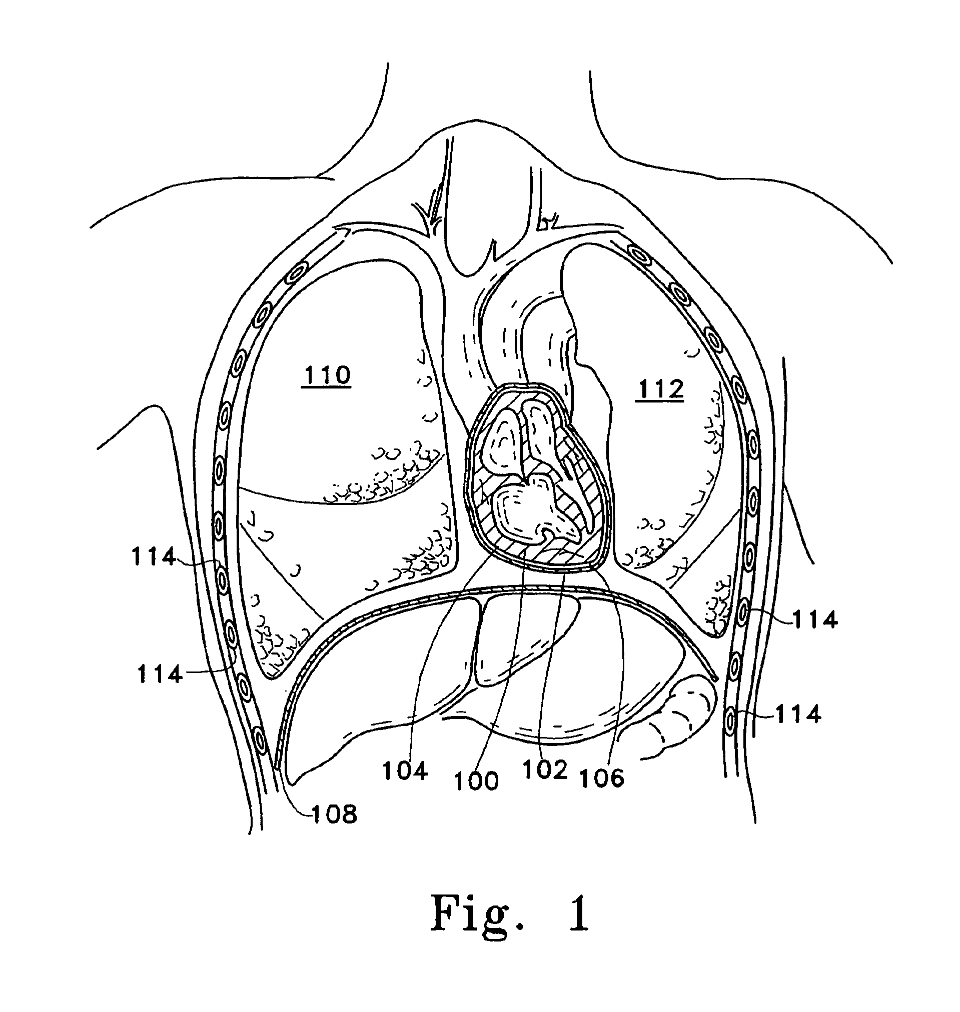 Pericardium reinforcing devices and methods of using them