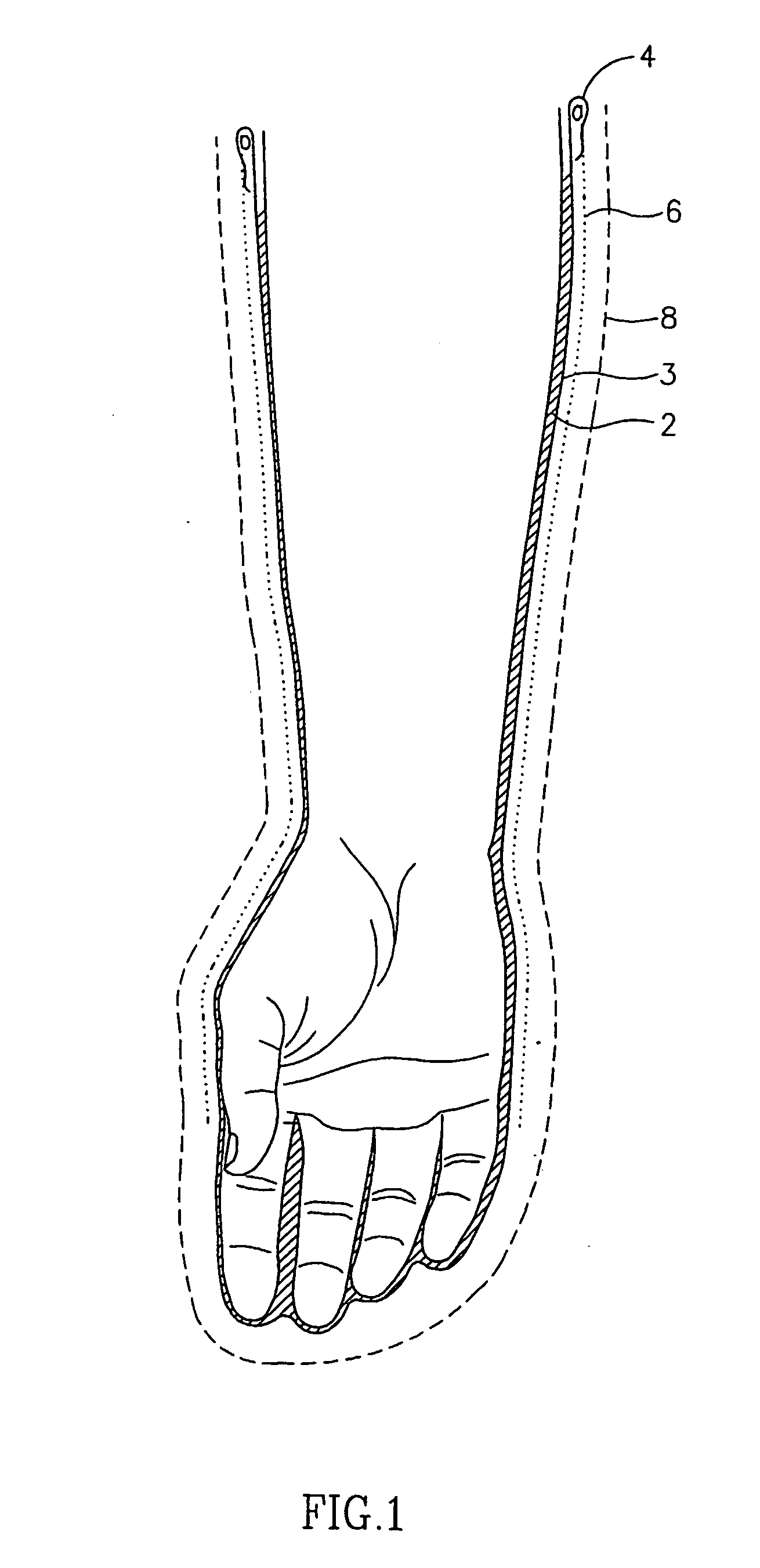 Apparatus and methods for enzymatic escharotomy in burn induced compartment syndrome