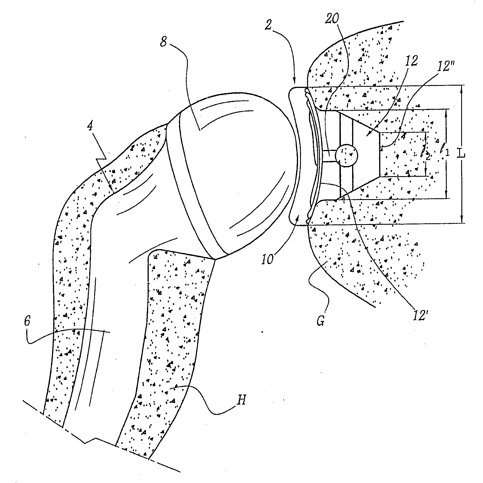 Glenoid component with an anatomically optimized keel