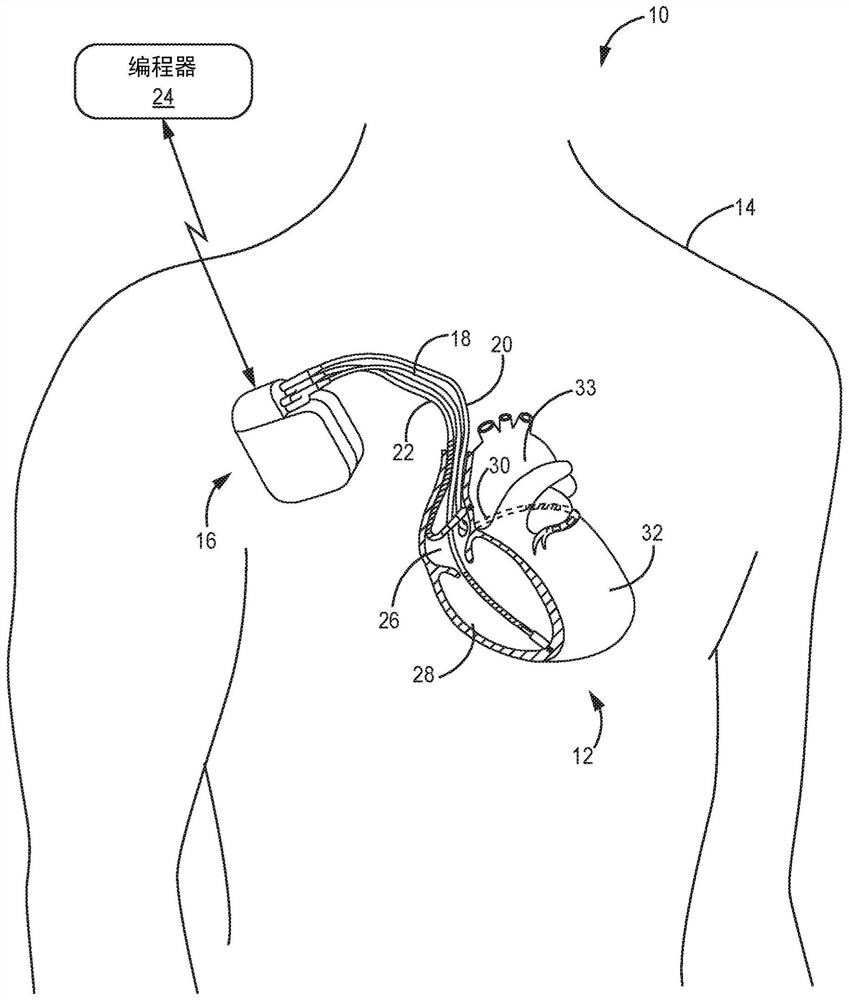 System for identification and adjustment of loss of effective cardiac resynchronization therapy