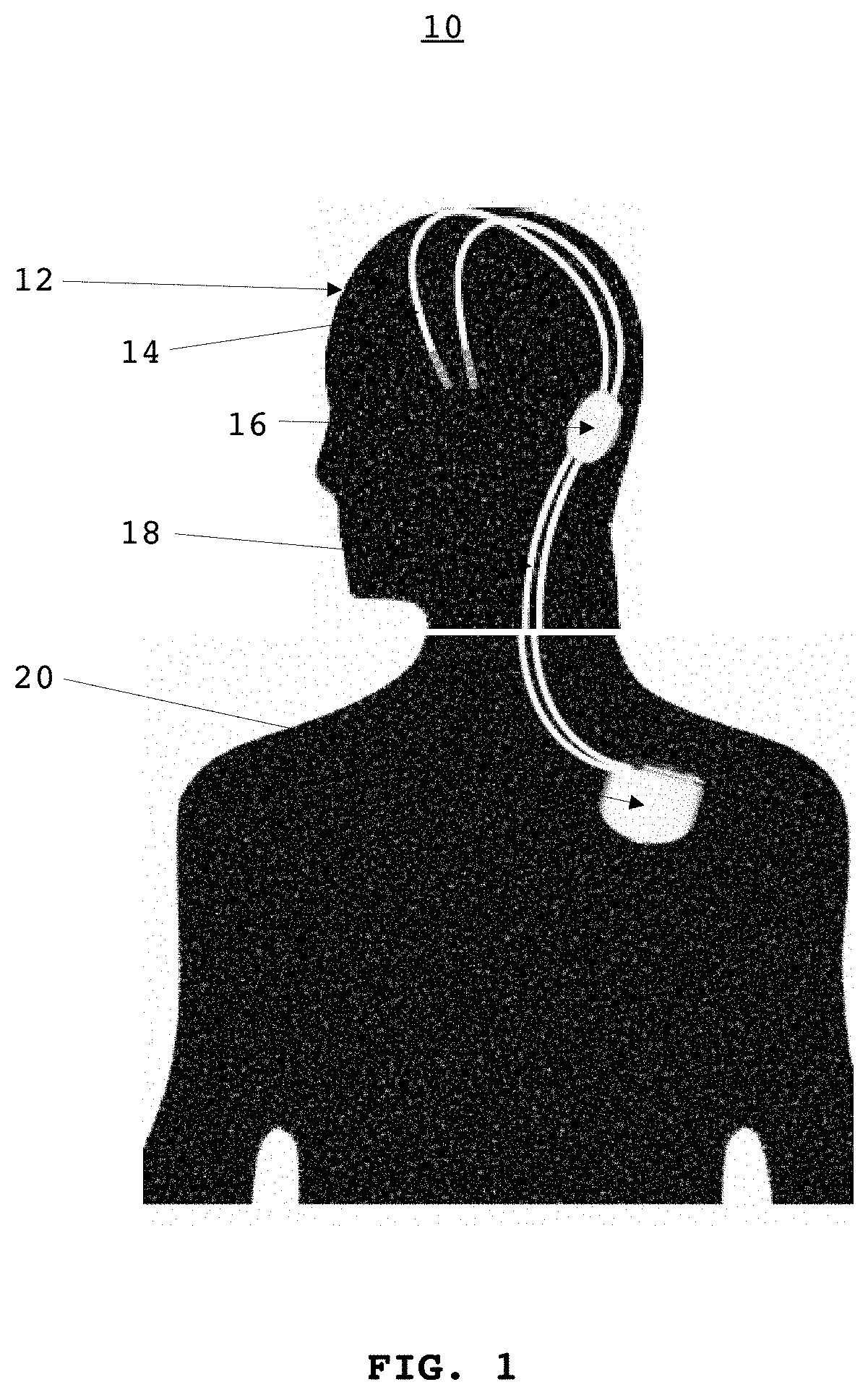 Brain implantable device