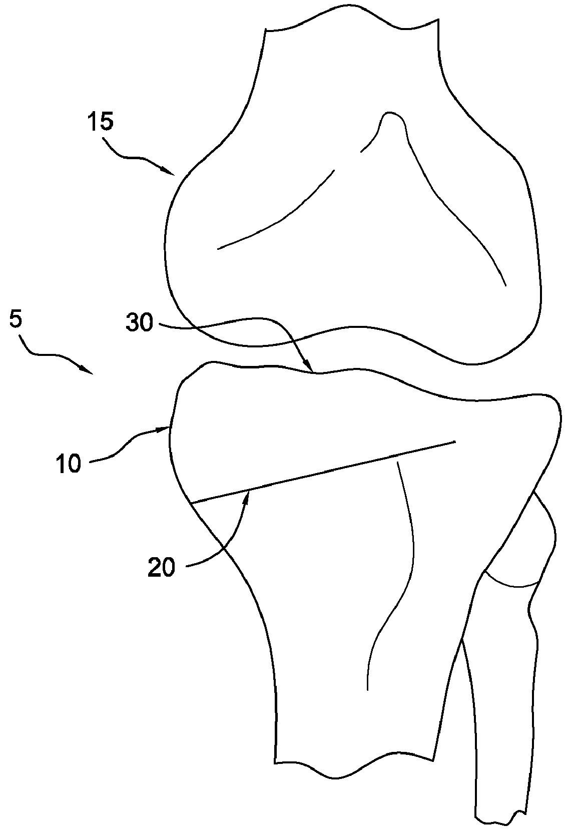 Method and apparatus for reconstructing a ligament and/or repairing cartilage, and for performing an open wedge, high tibial osteotomy