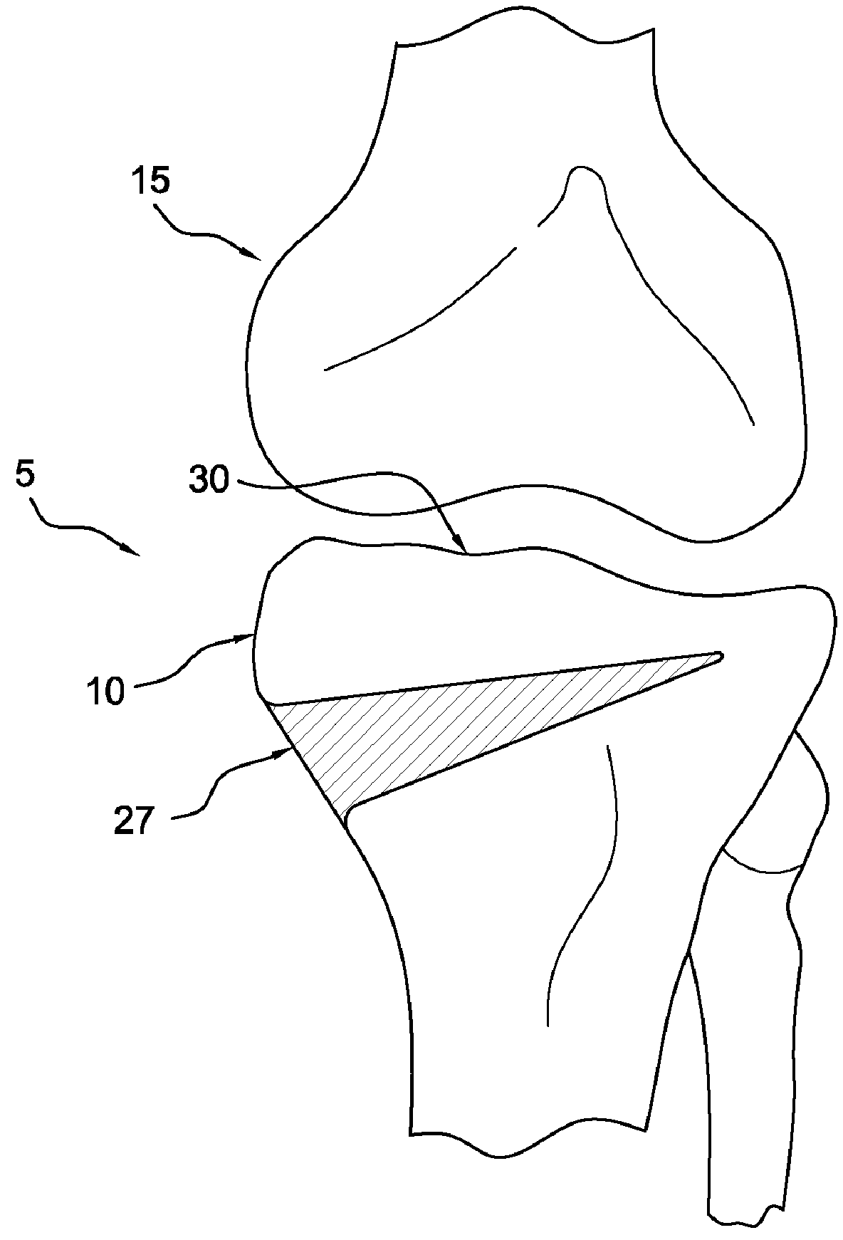 Method and apparatus for reconstructing a ligament and/or repairing cartilage, and for performing an open wedge, high tibial osteotomy