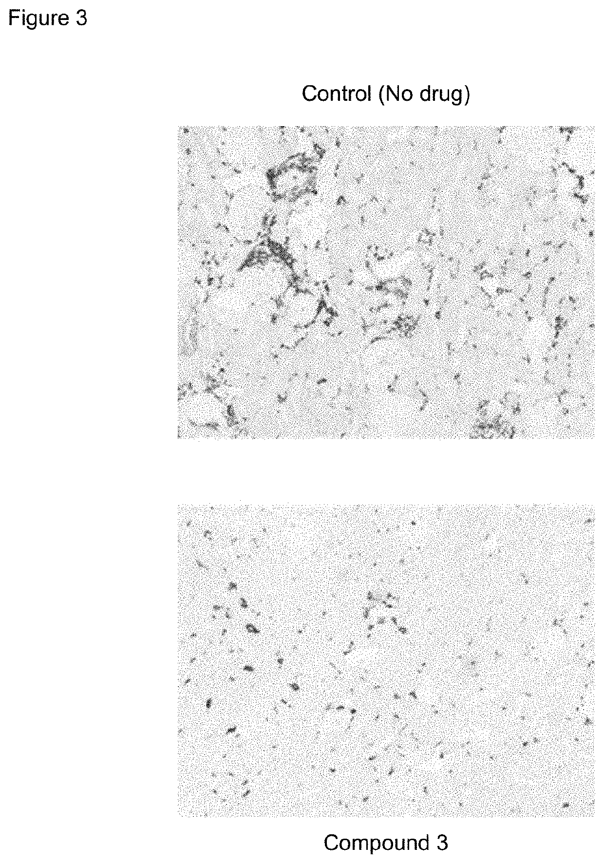 Method of Treating Focal Segmental Glomerulosclerosis