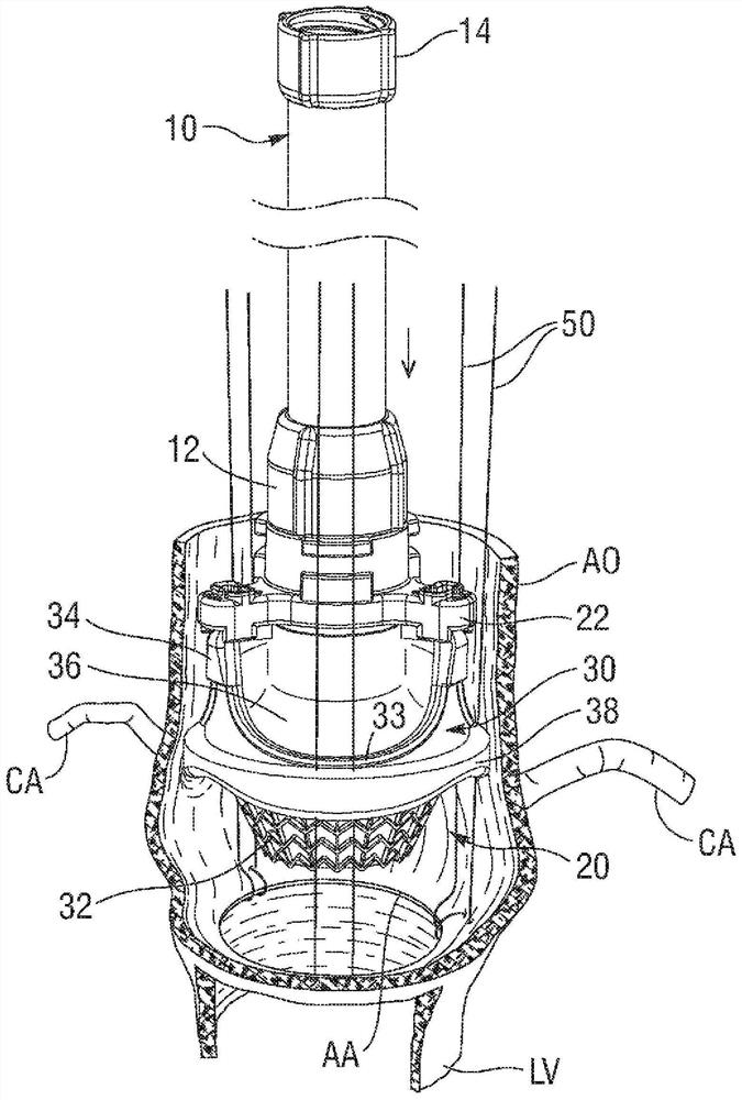 Heart valve deployment assist device