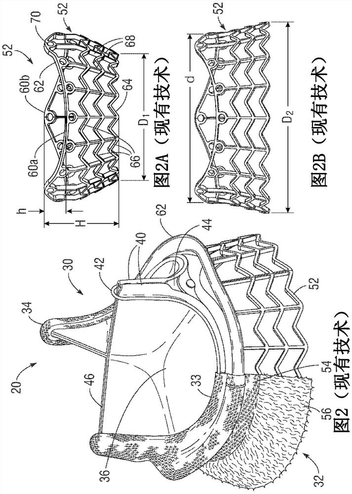 Heart valve deployment assist device