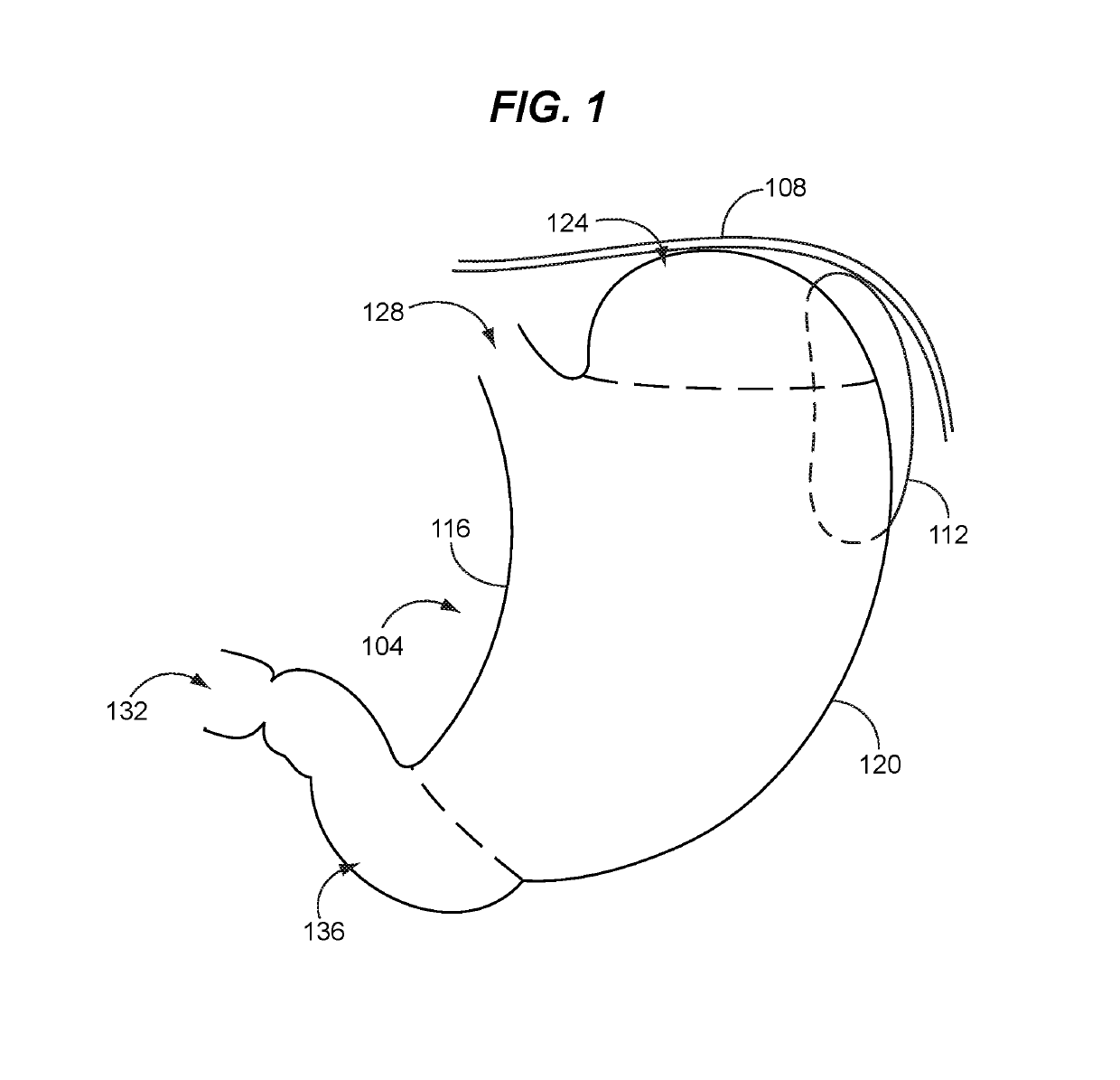 Safe sleeve gastrectomy and intestinal switch
