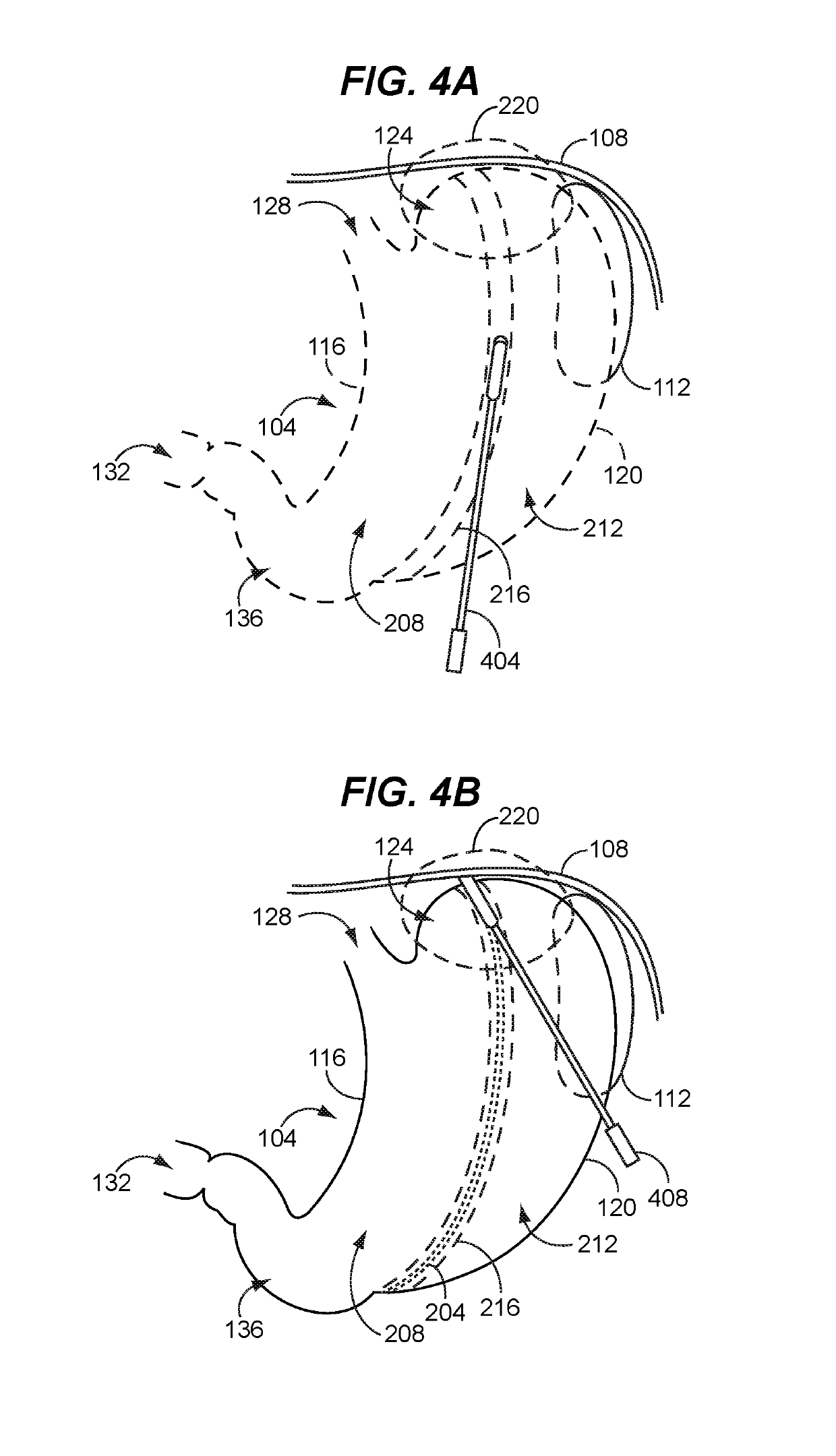 Safe sleeve gastrectomy and intestinal switch