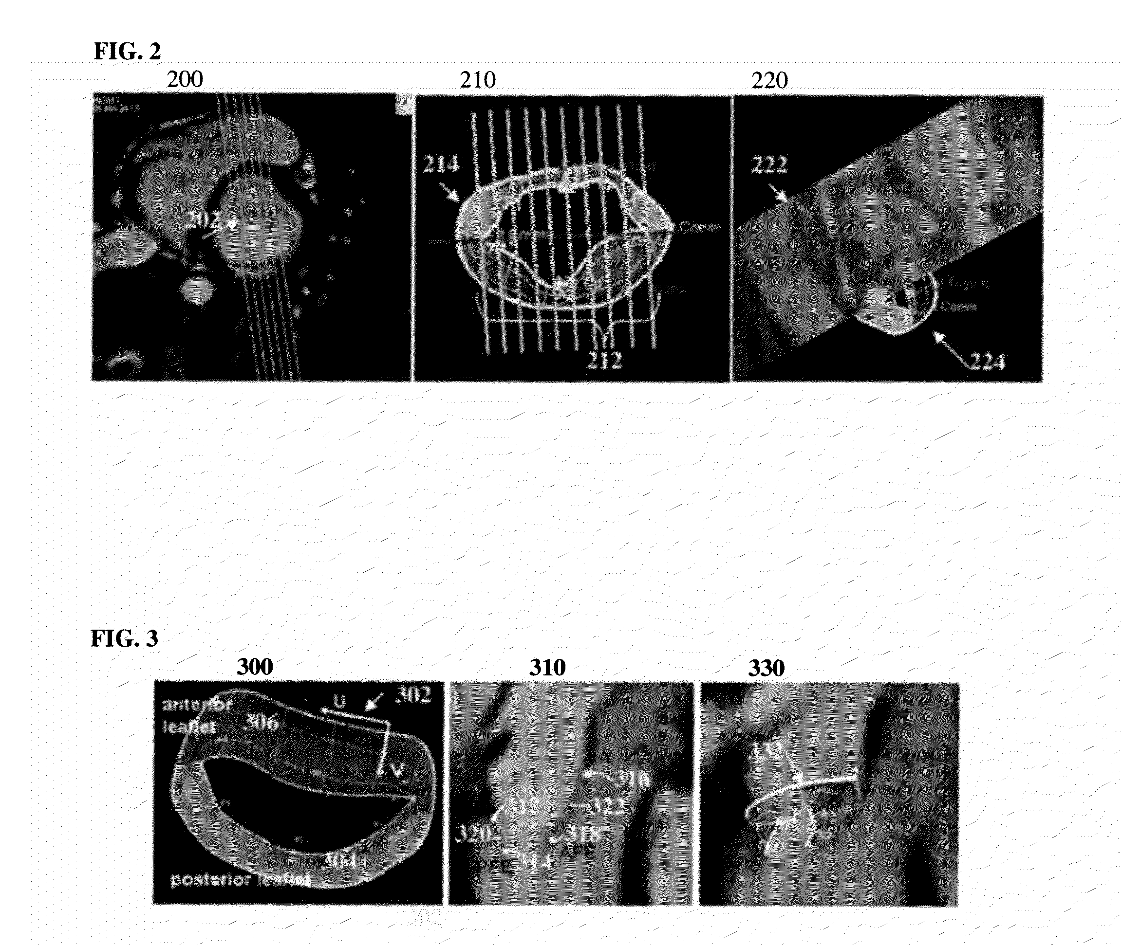 Method and System for Regression-Based 4D Mitral Valve Segmentation From 2D+t Magnetic Resonance Imaging Slices