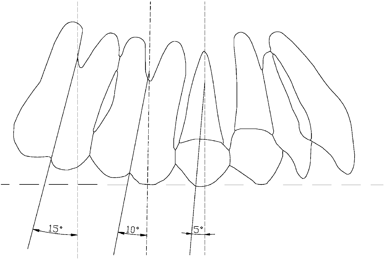 A molar anchorage control method for invisible orthodontic treatment of tooth extraction cases