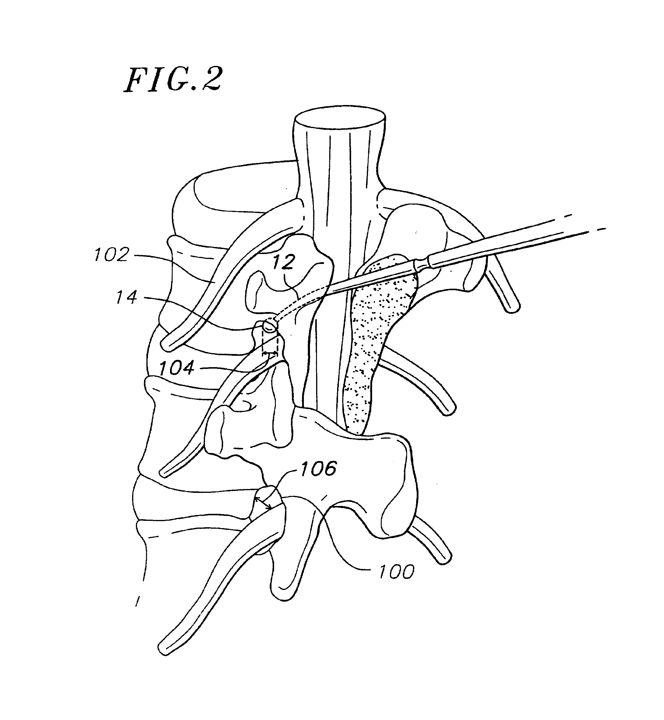 System, method and apparatus for locating, measuring and evaluating the enlargement of a foramen