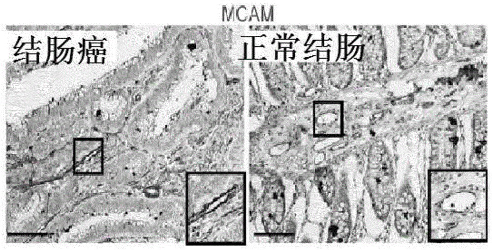 Hepatocarcinoma marker melanoma cell-adhesion molecule and application thereof