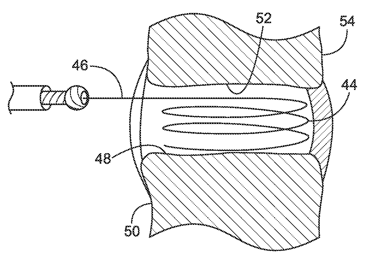 Tissue Removal Tools And Methods Of Use