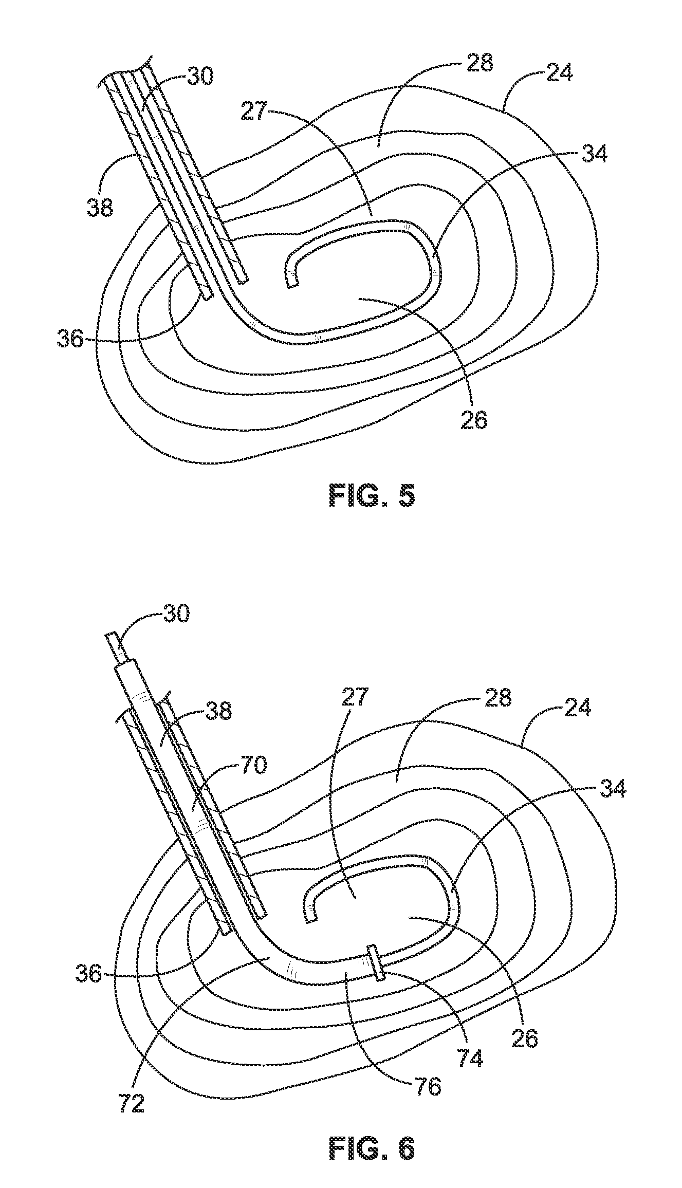 Tissue Removal Tools And Methods Of Use