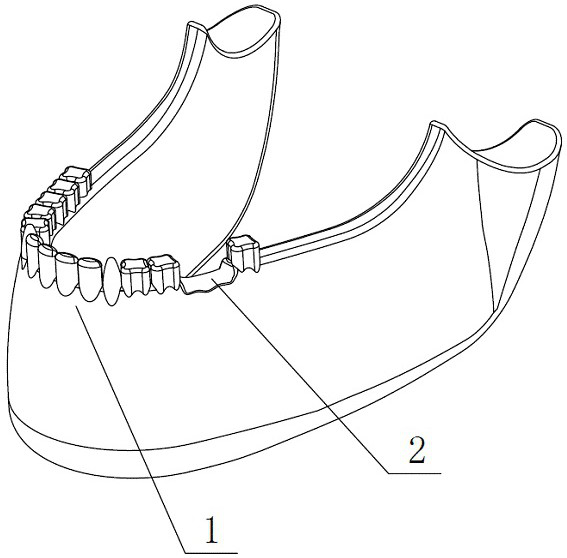 Preparation method of personalized titanium mesh for bone defect reconstruction in tooth implantation area