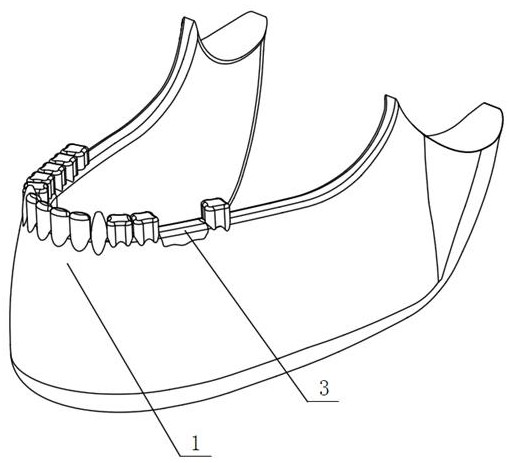 Preparation method of personalized titanium mesh for bone defect reconstruction in tooth implantation area