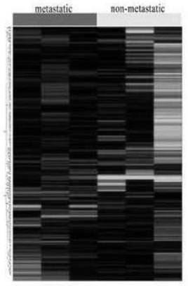 CircRNA related to malignant melanoma and application of circRNA