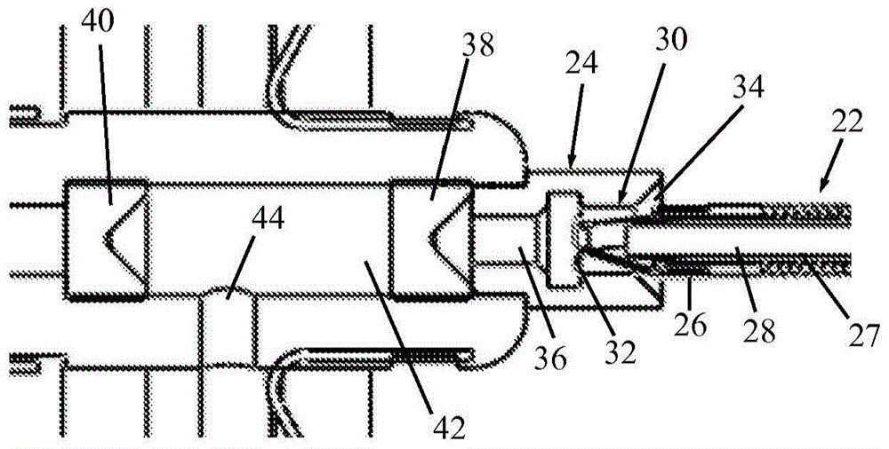 Inflatable obstruction device for the pyloric sphincter