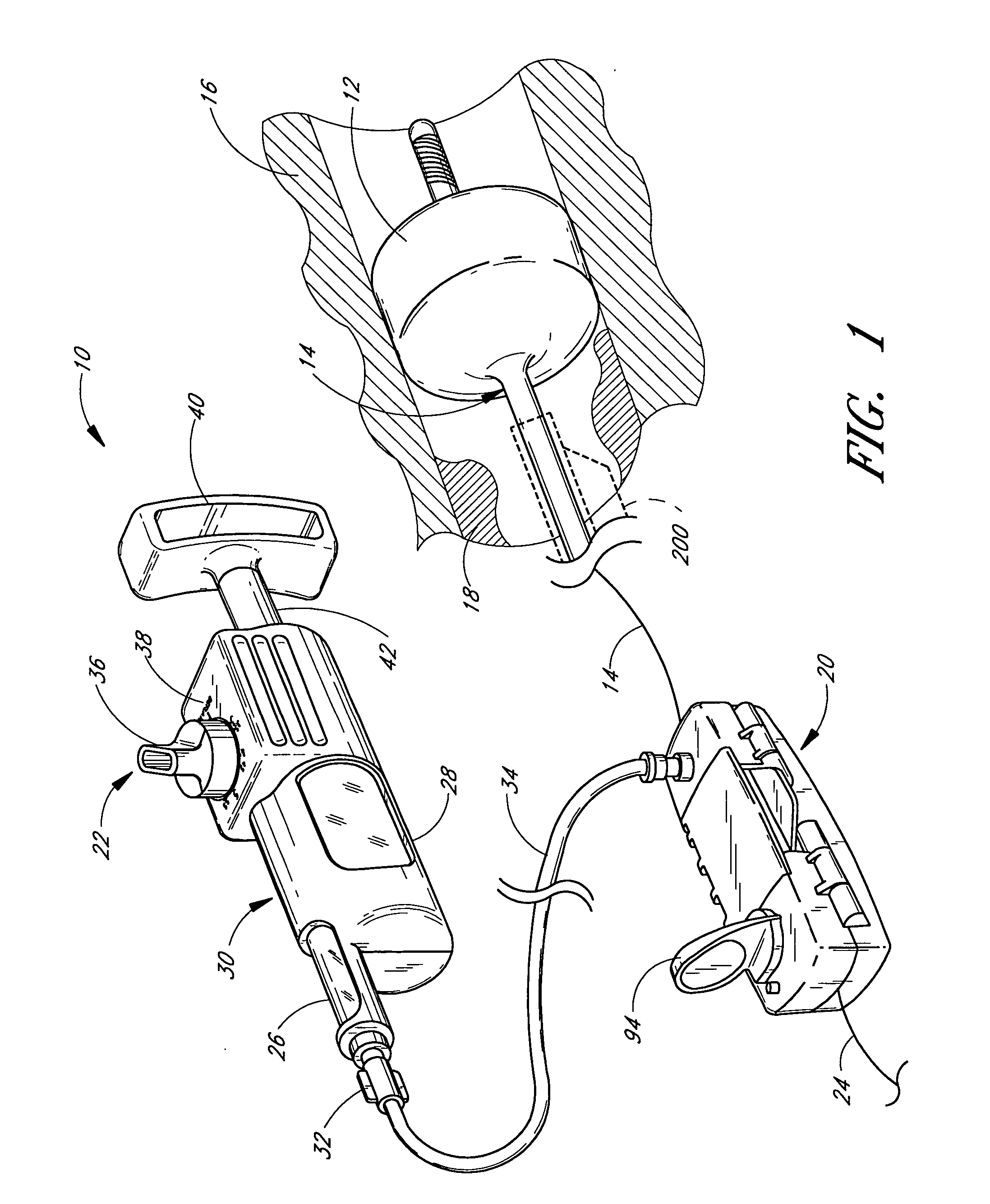 Method and apparatuses for treating an intravascular occlusion
