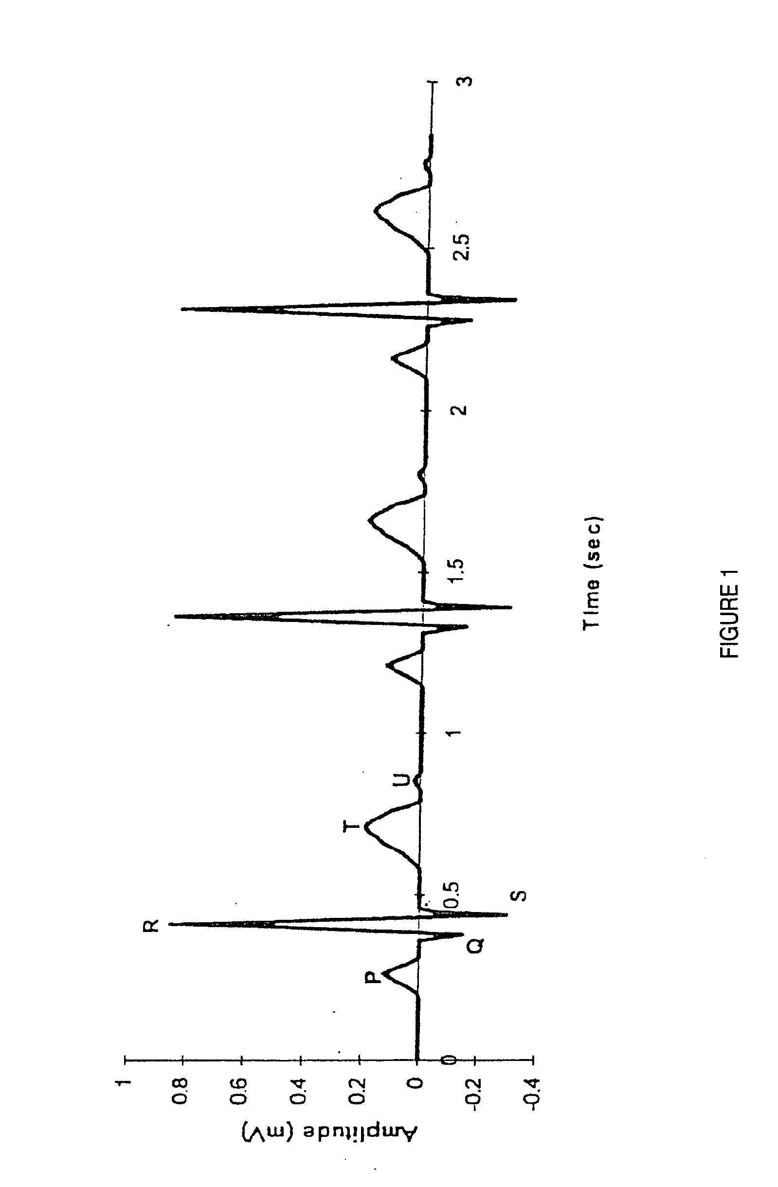 Method and system for processing electrocardial signals
