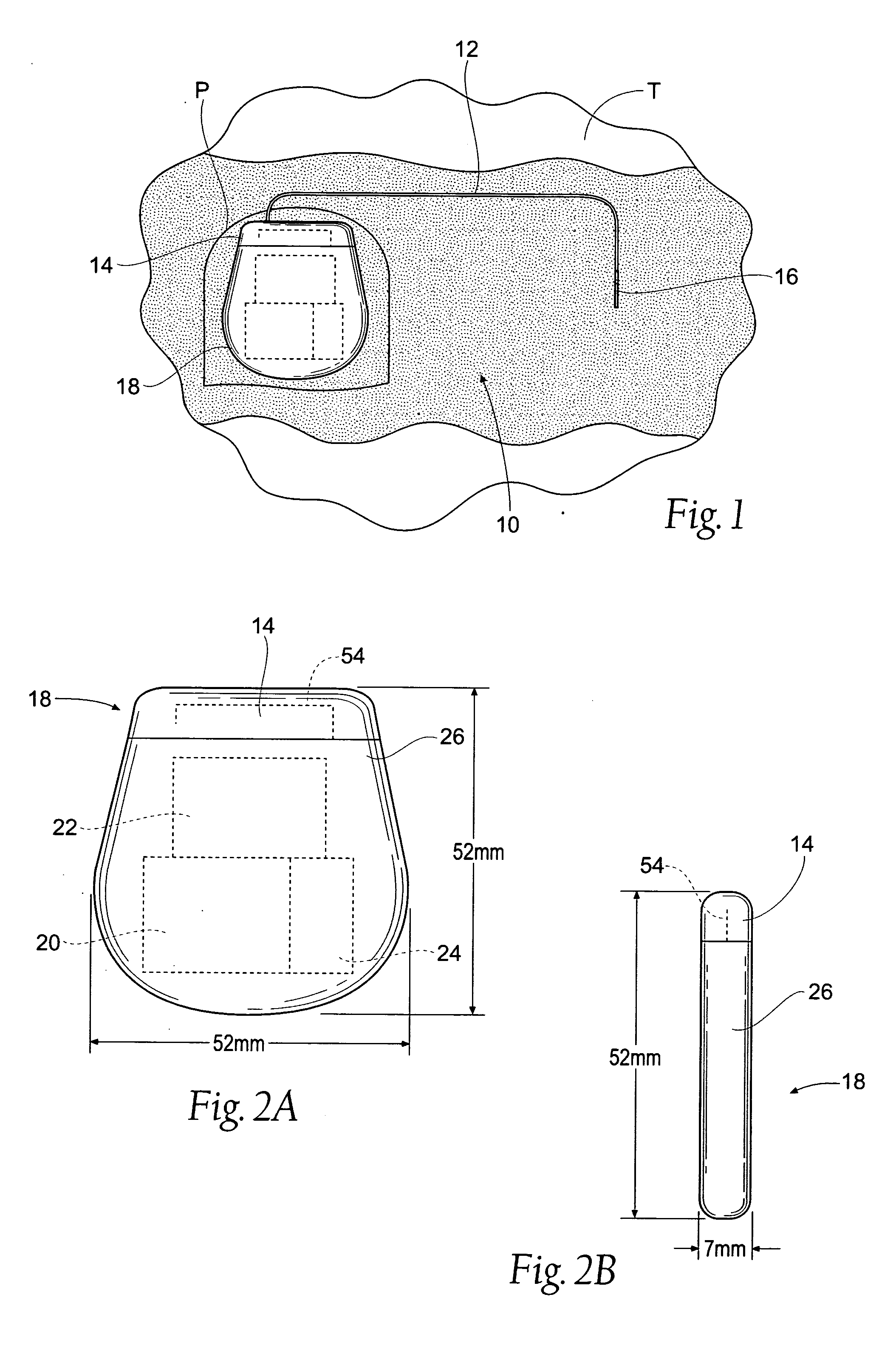 Implantable pulse generator for providing functional and/or therapeutic stimulation of muscles and/or nerves and/or central nervous system tissue