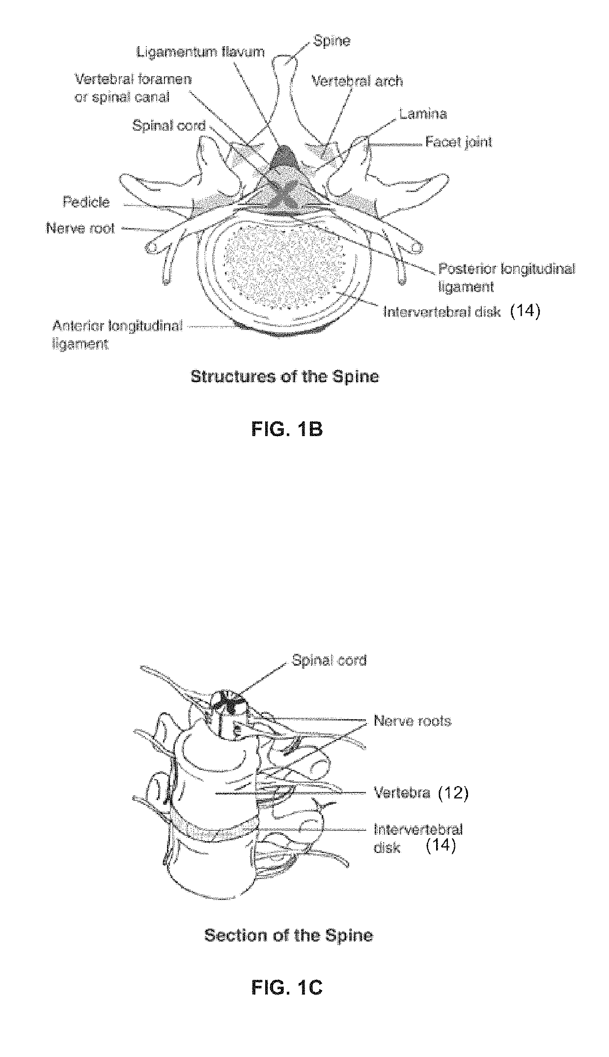 Apparatus, kit, and method for percutaneous intervertebral disc restoration