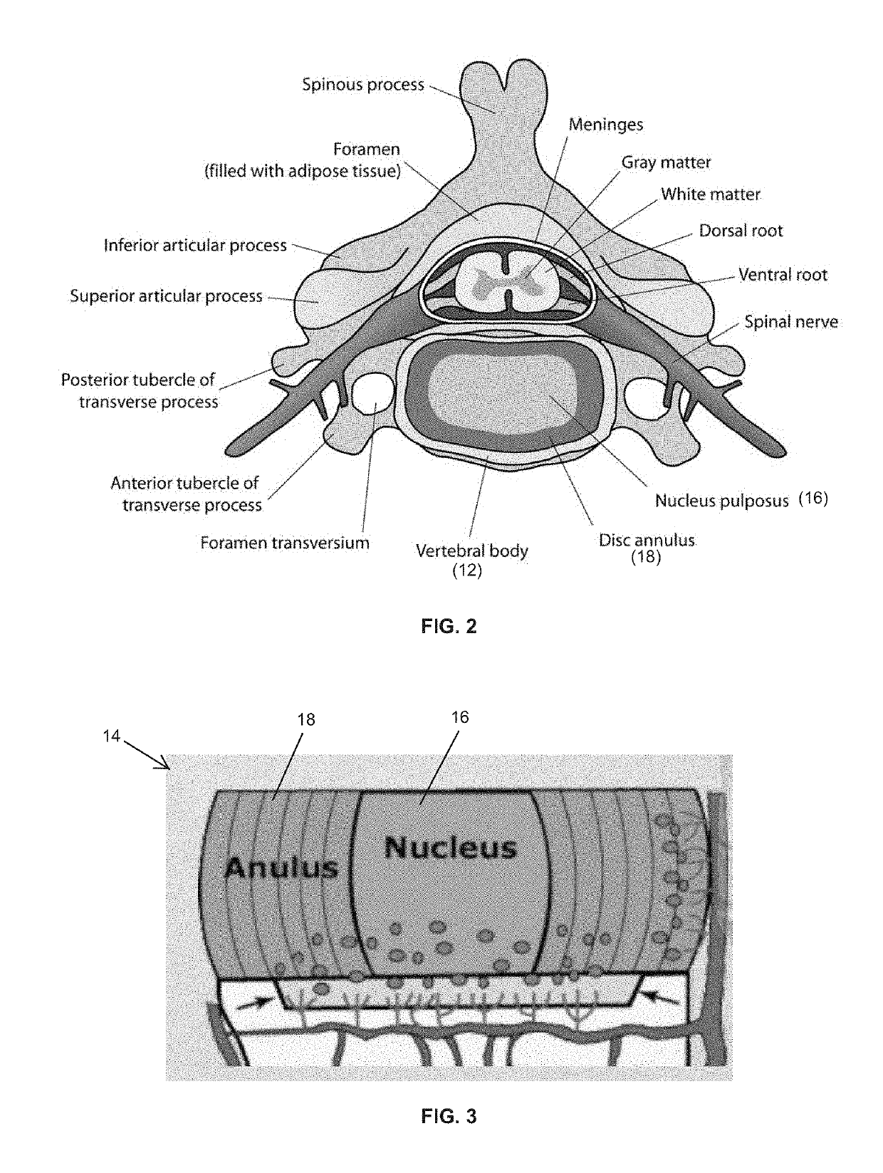 Apparatus, kit, and method for percutaneous intervertebral disc restoration
