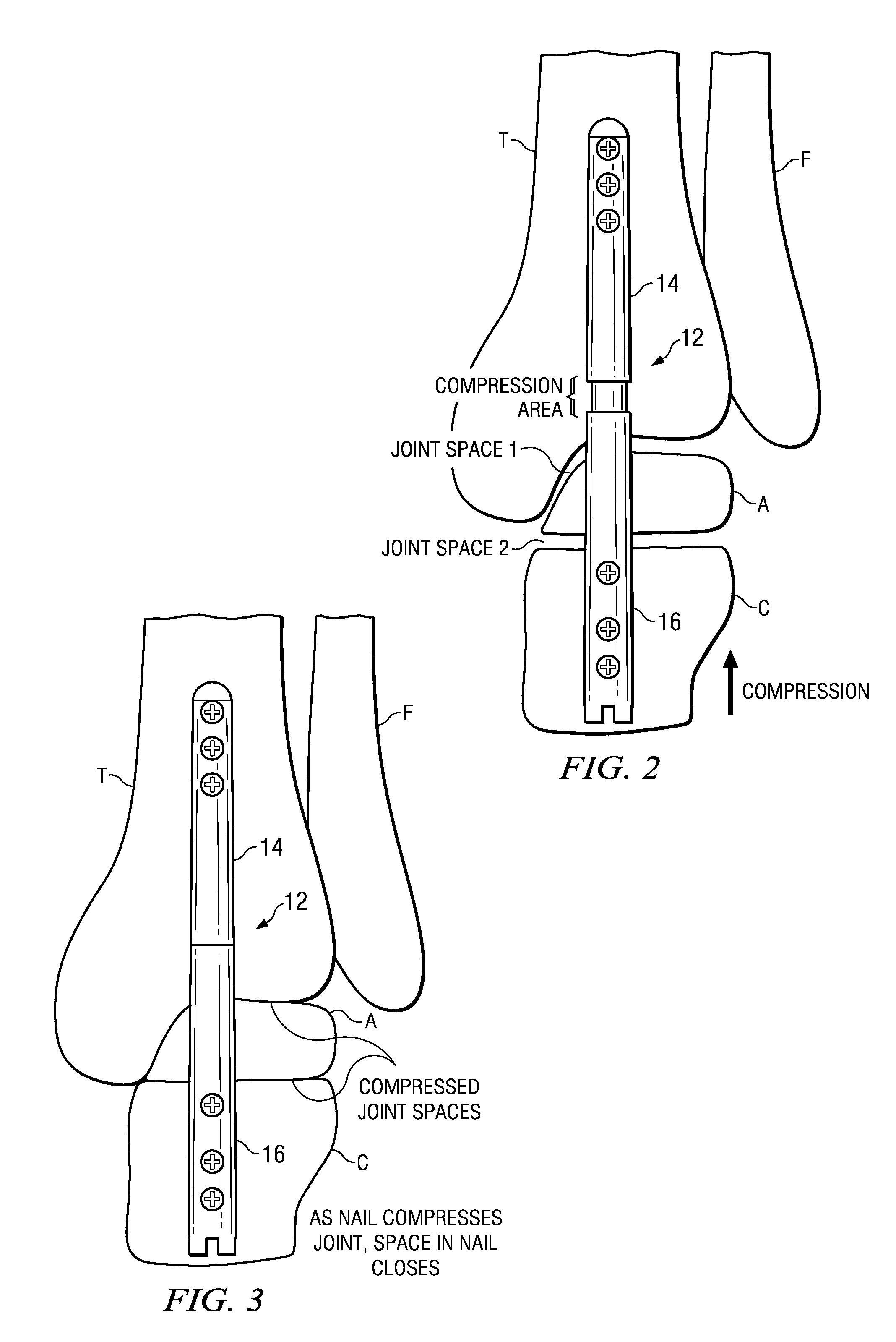 Ankle arthrodesis nail and outrigger assembly