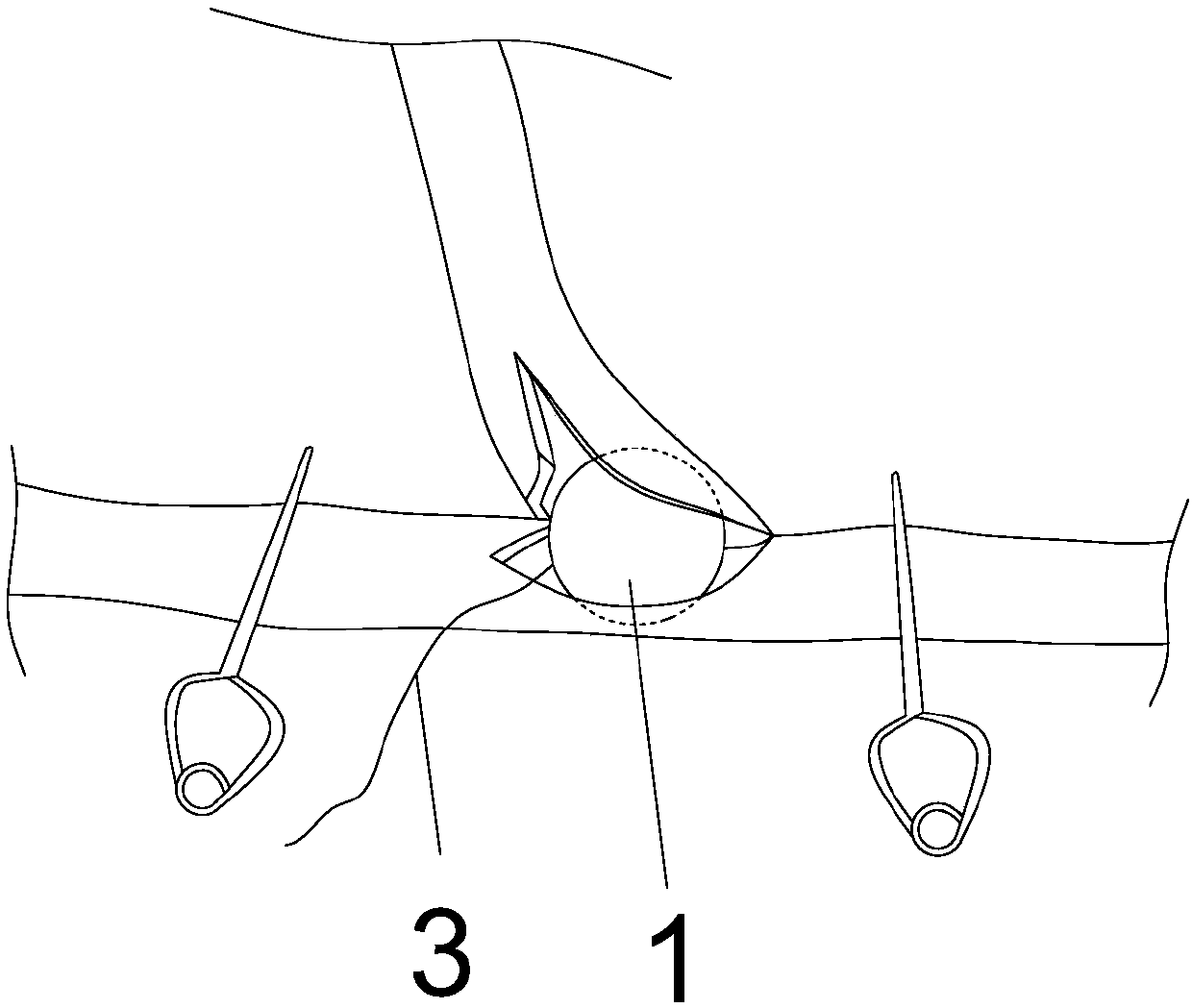 Small vascular bypass intra-operative auxiliary stoma forming device
