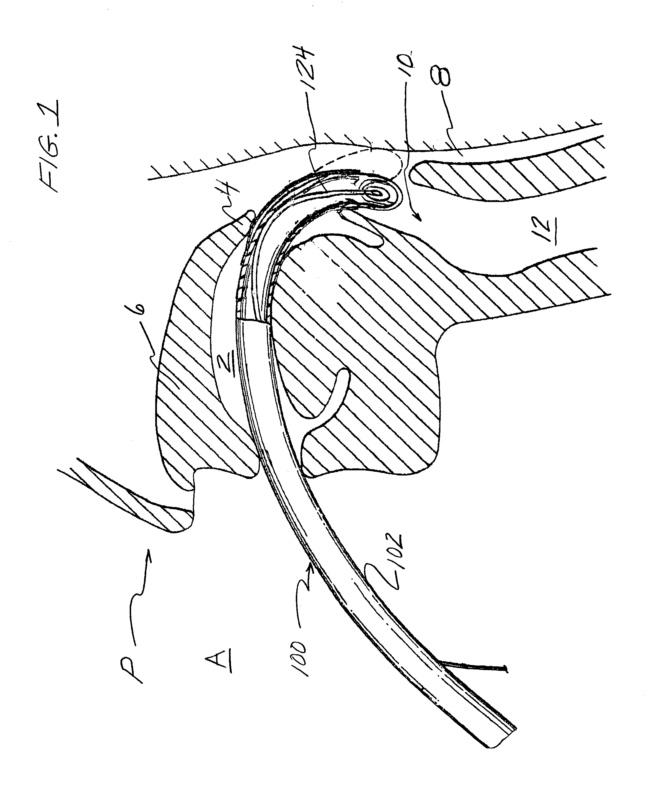 Intubation device