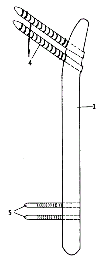 Locking support for treating femoral intertrochanteric fracture through minimally invasive therapy