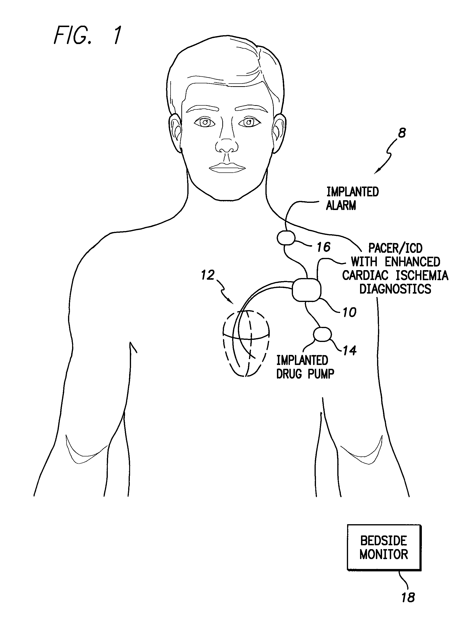 System and method for generating and using cardiac ischemia diagnostics based on arrhythmia precursors and arrhythmia episodes