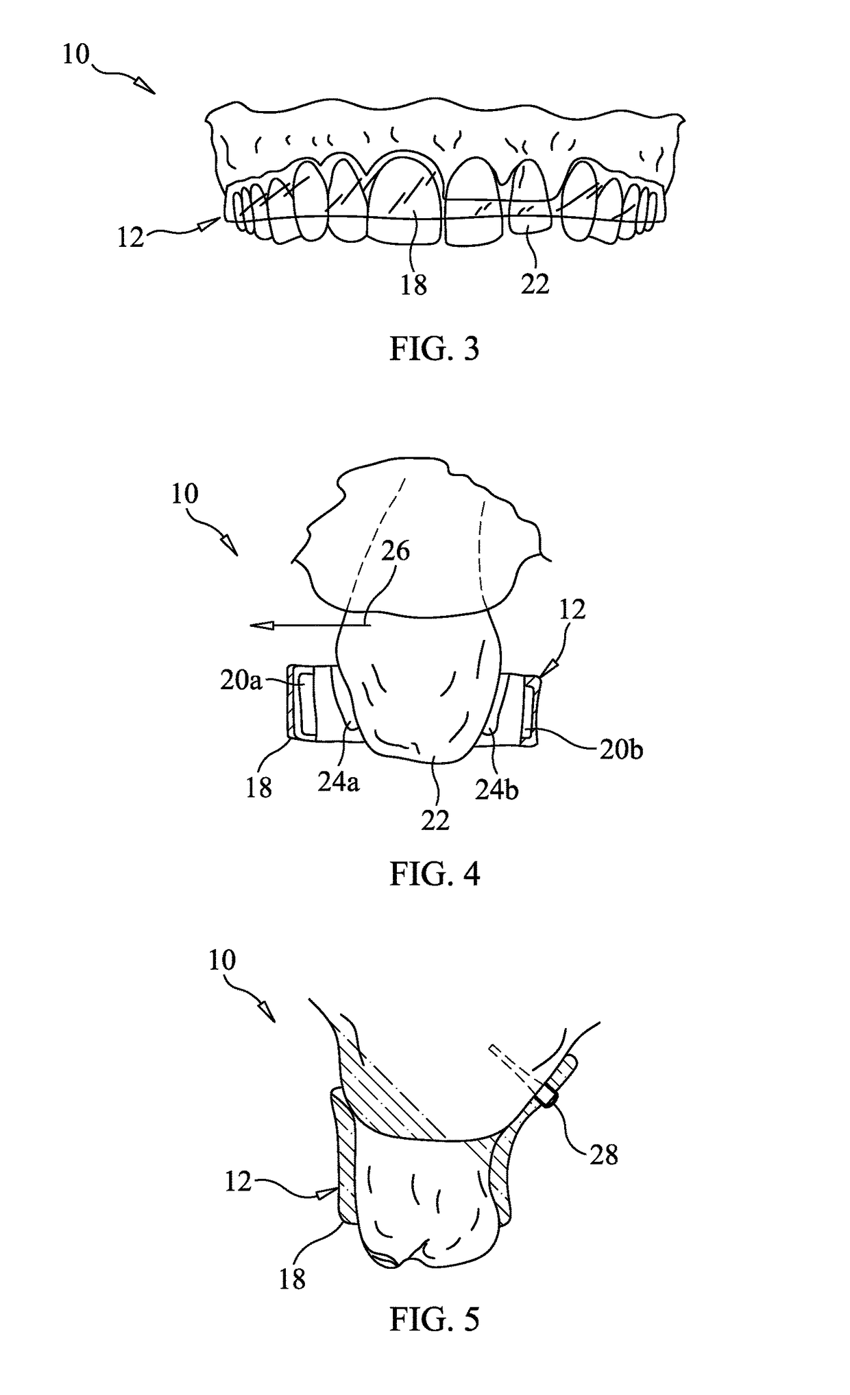 Apparatus and method for correcting orthodontic malocclusions