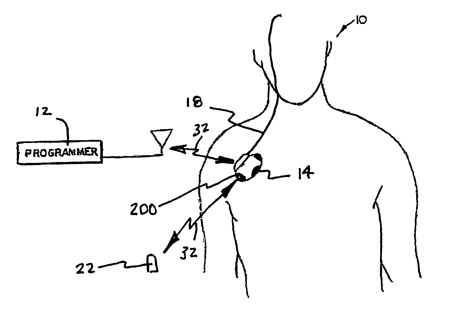 System and method for monitoring or treating nervous system disorders