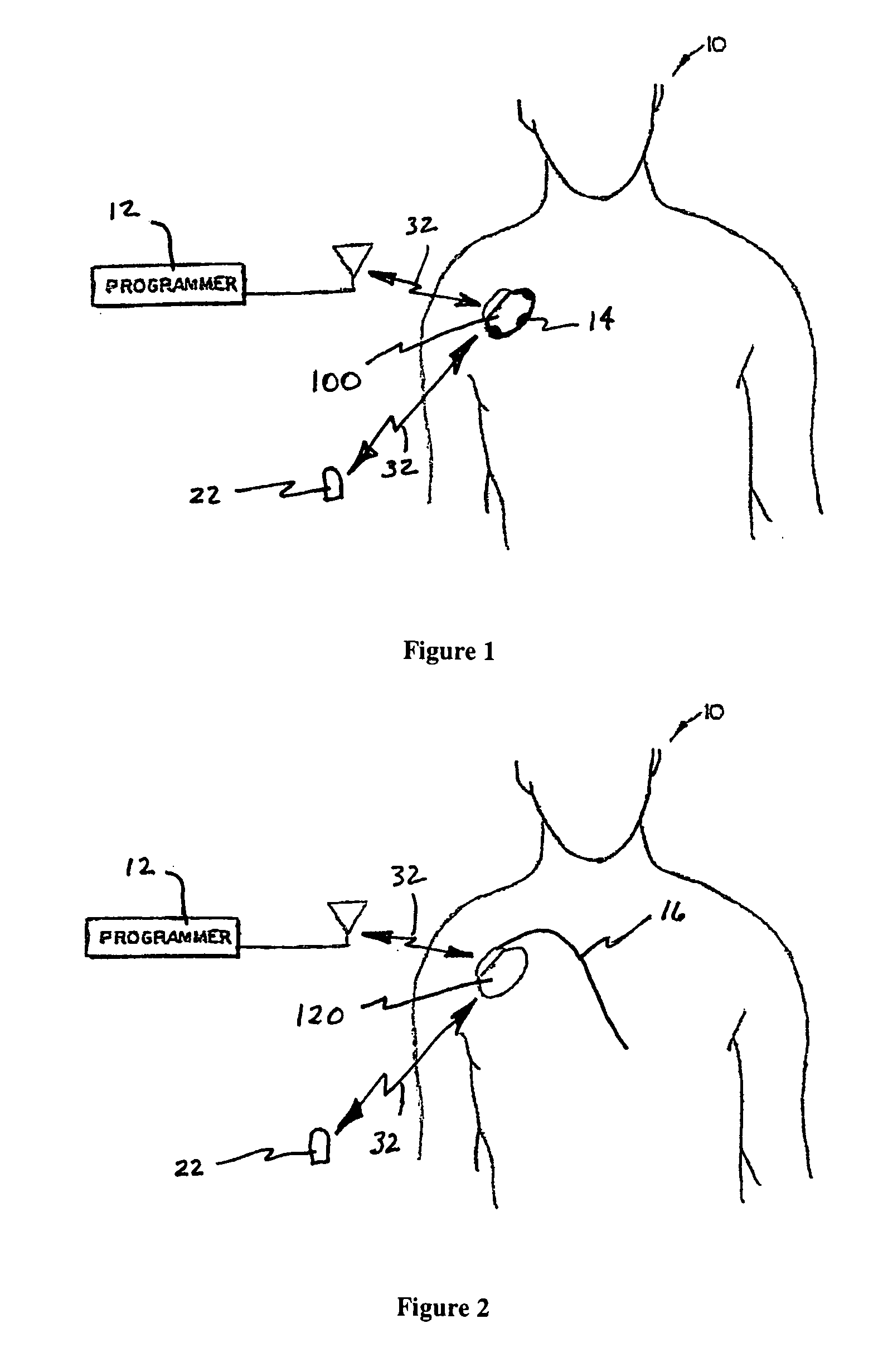 System and method for monitoring or treating nervous system disorders
