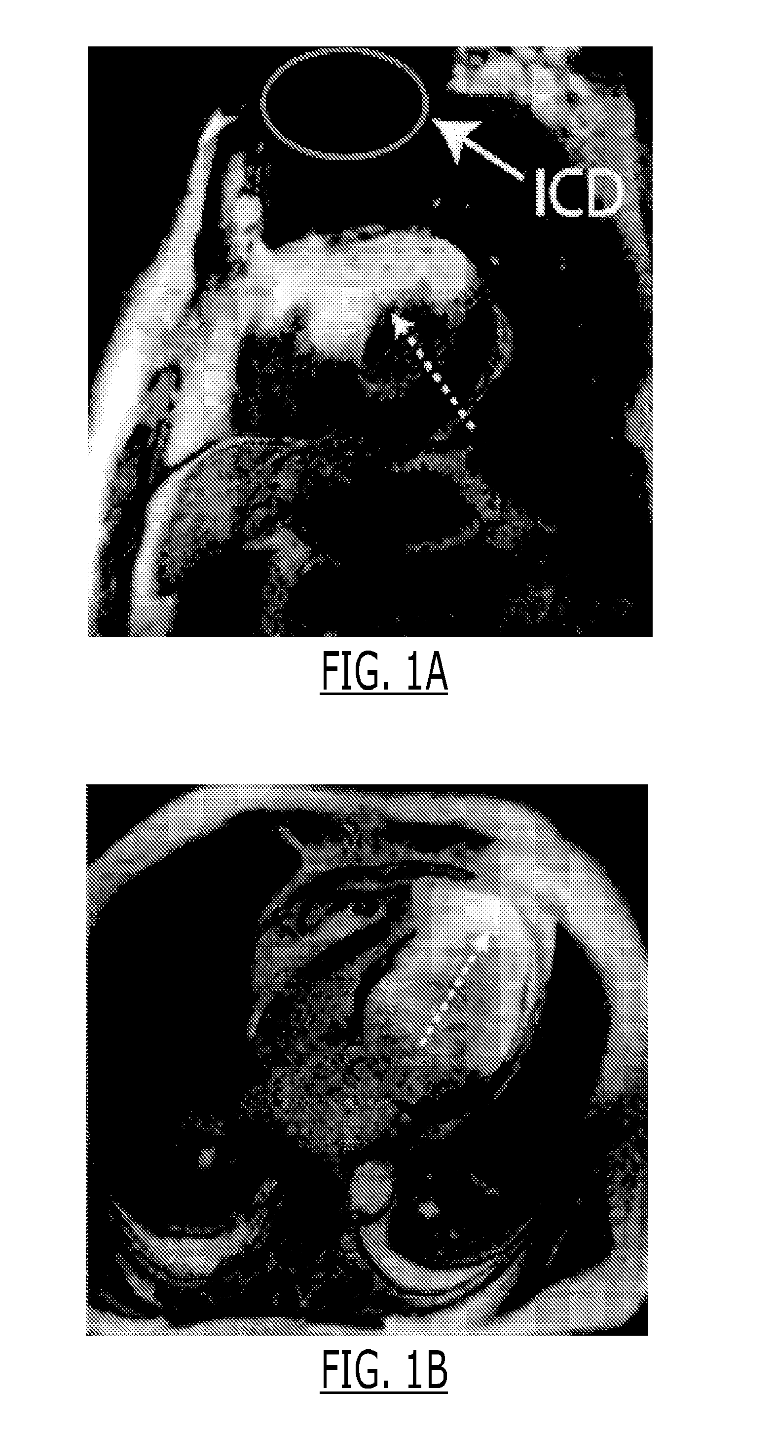 Cardiac late gadolinium enhancement MRI for patients with implanted cardiac devices