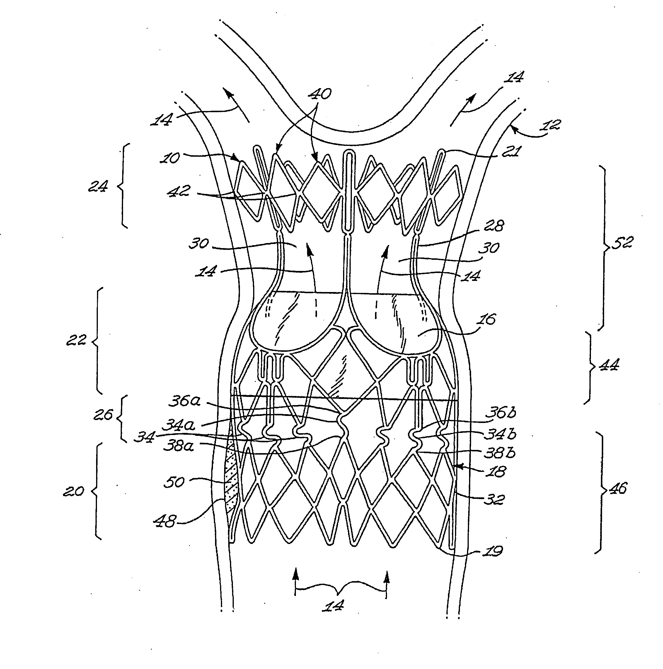 Stent valve and method of using same