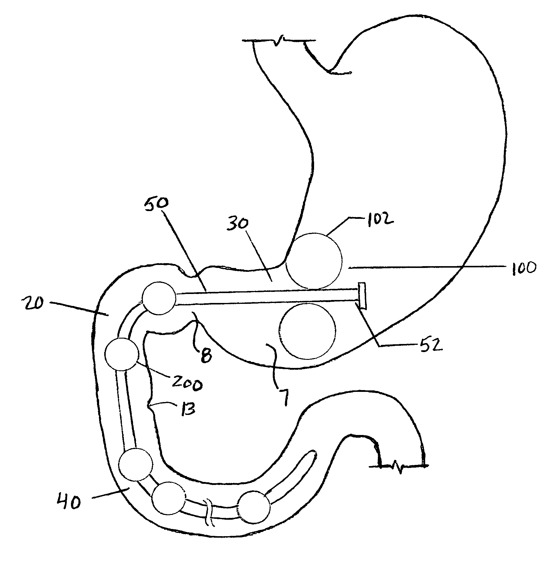 Method and apparatus for reducing obesity