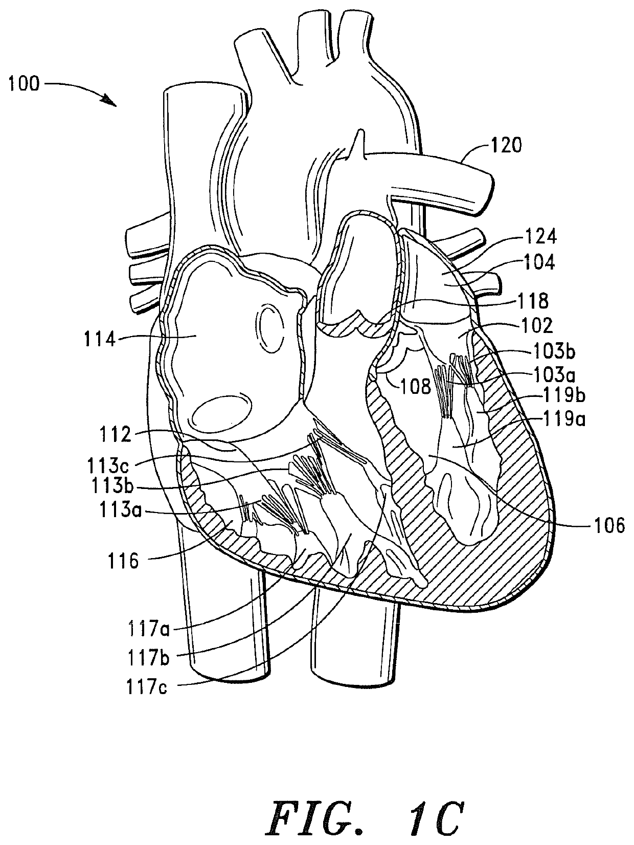 Prosthetic cardiovascular valves and methods for replacing native atrioventricular valves with same
