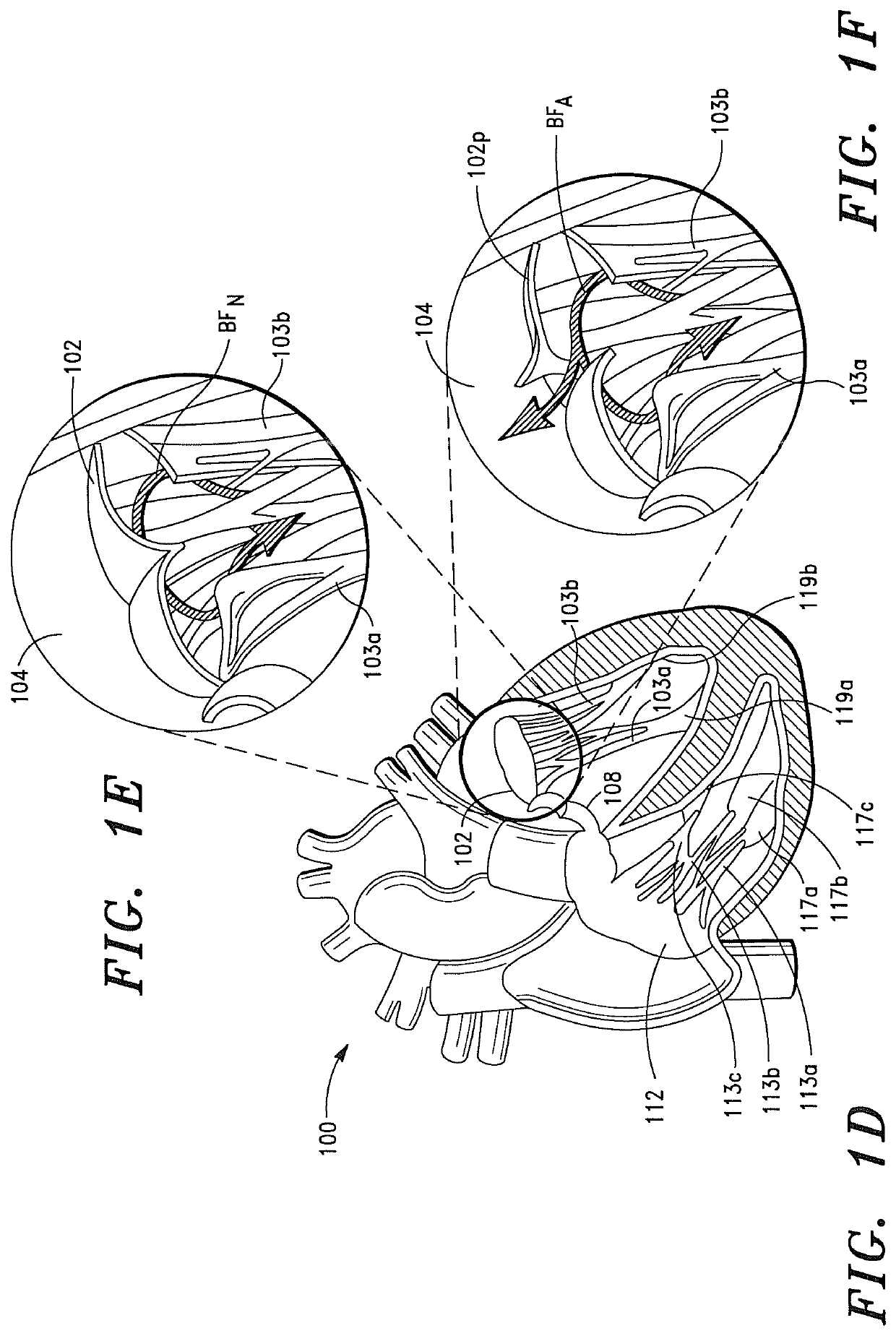 Prosthetic cardiovascular valves and methods for replacing native atrioventricular valves with same