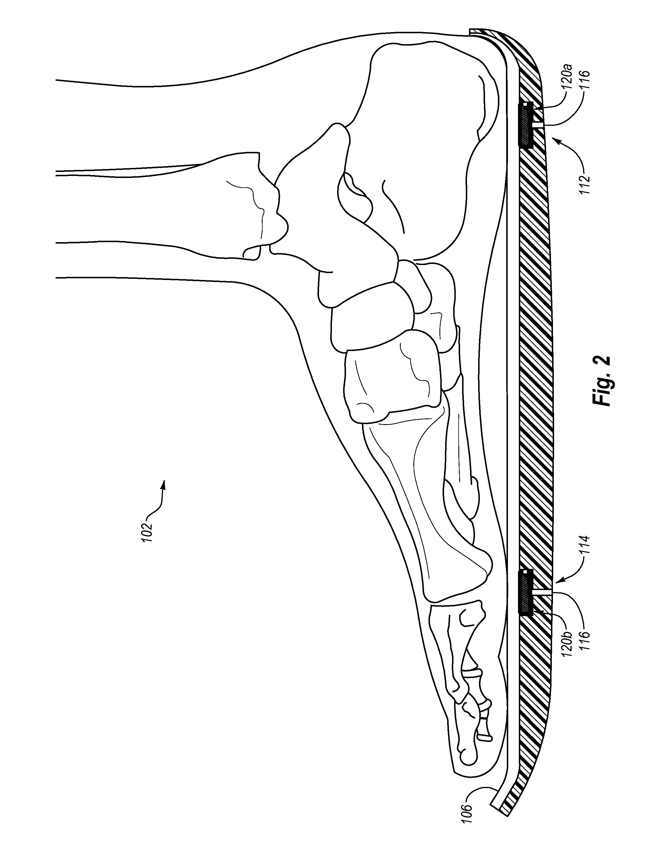 Systems, devices, and methods for monitoring an under foot load profile of a tibial fracture patient during a period of partial weight bearing