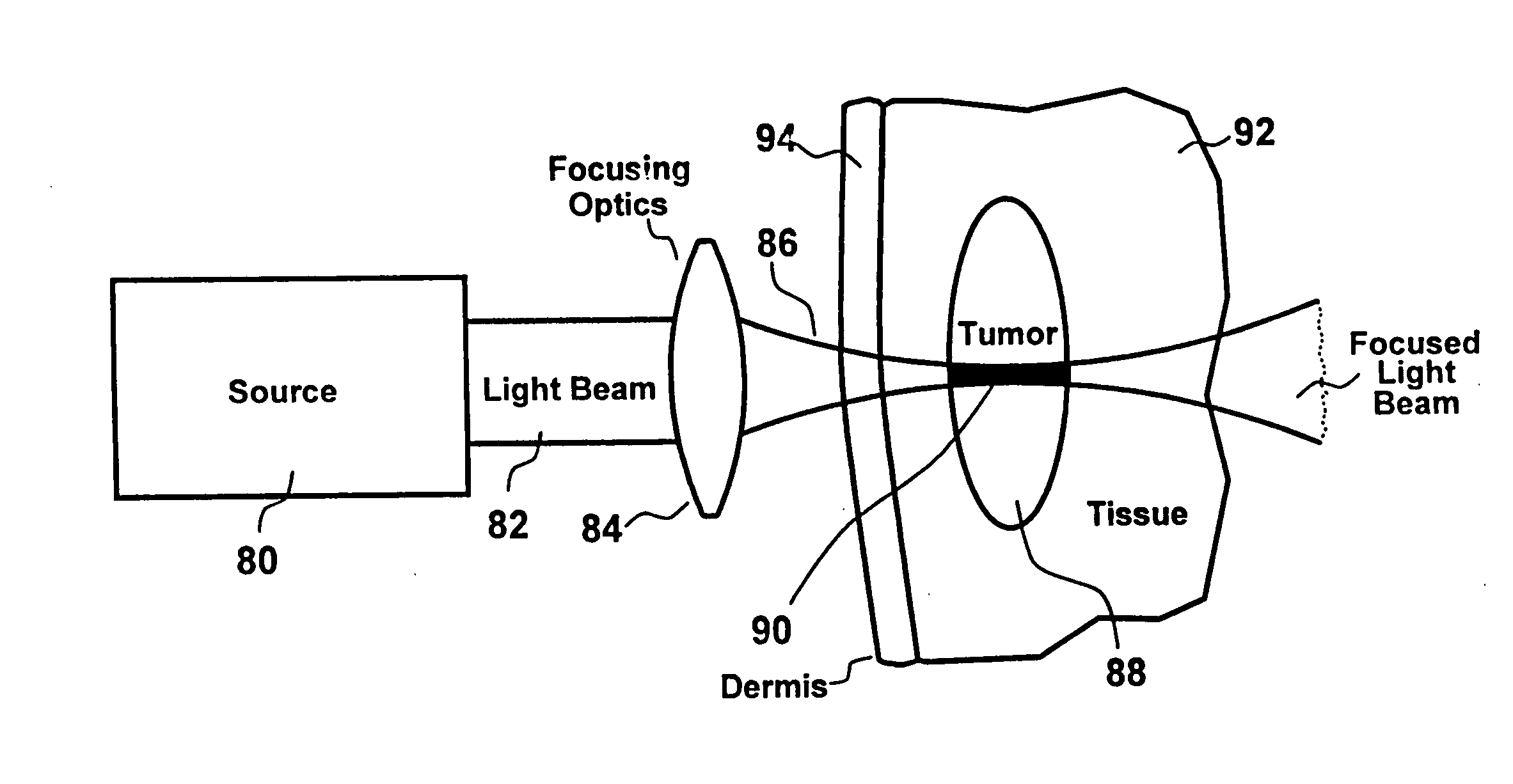 Treatment of pigmented tissue using optical energy