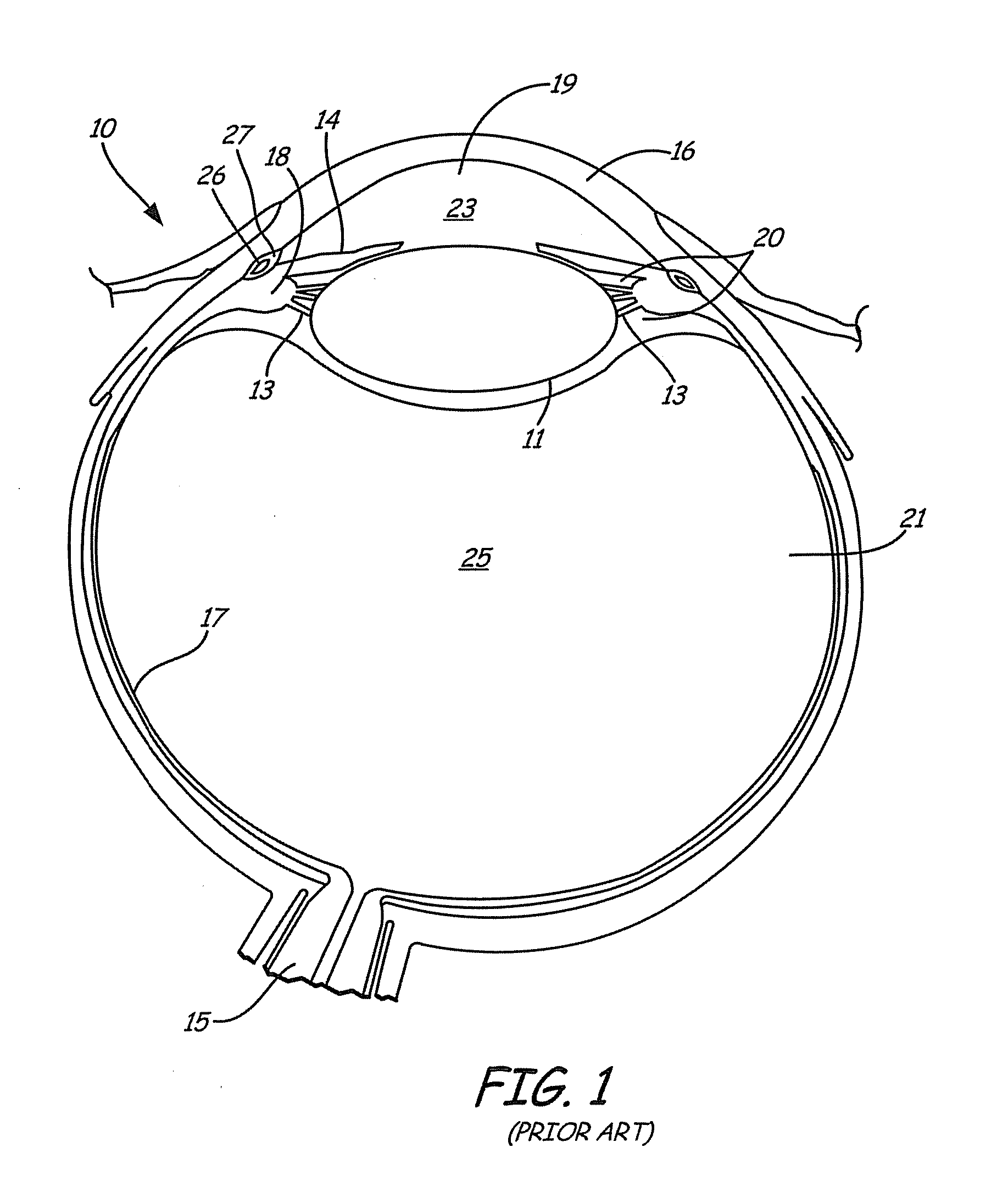 Method and apparatus for prevention and treatment of adult glaucoma