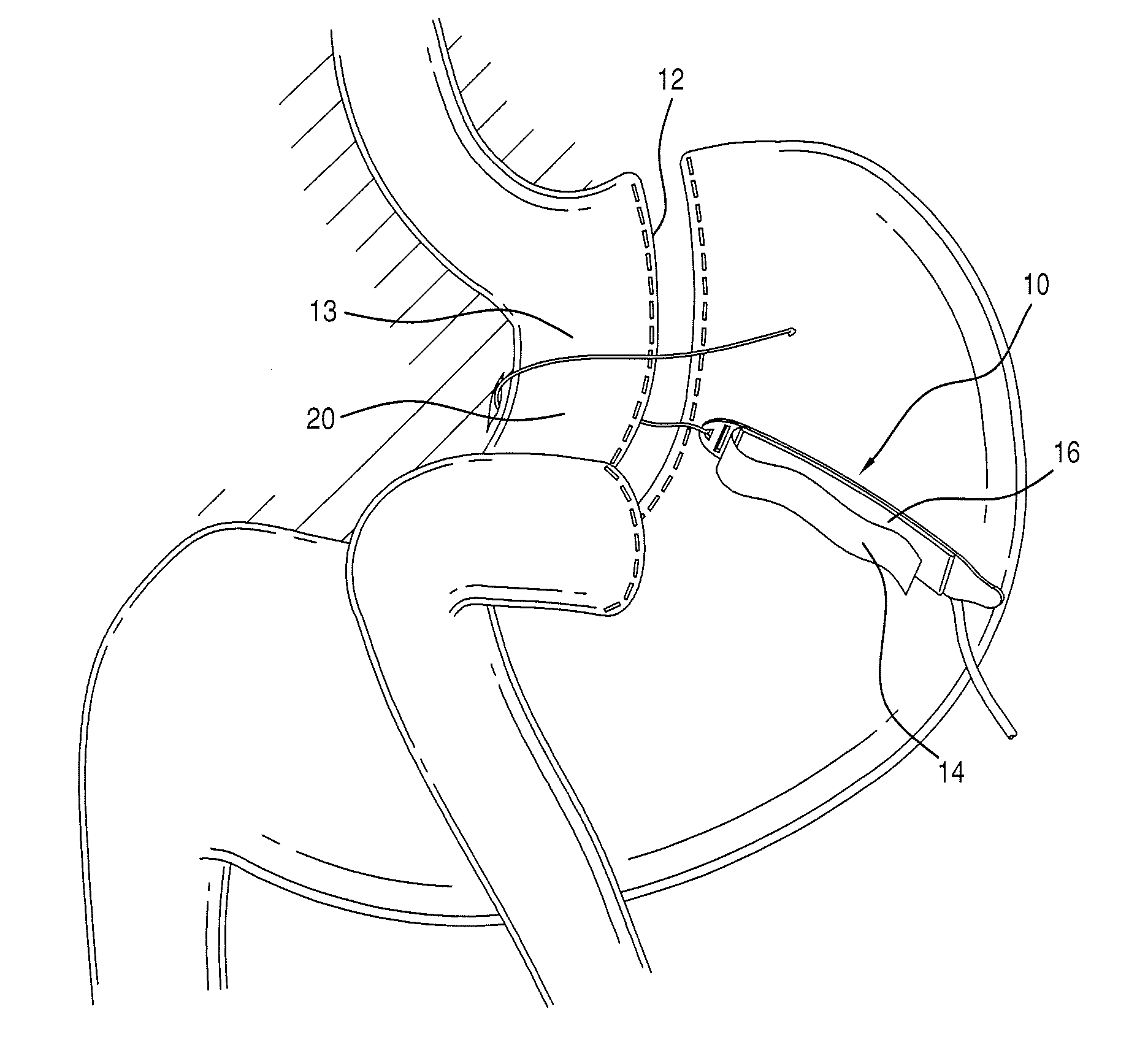 Implantable restriction device with spacer