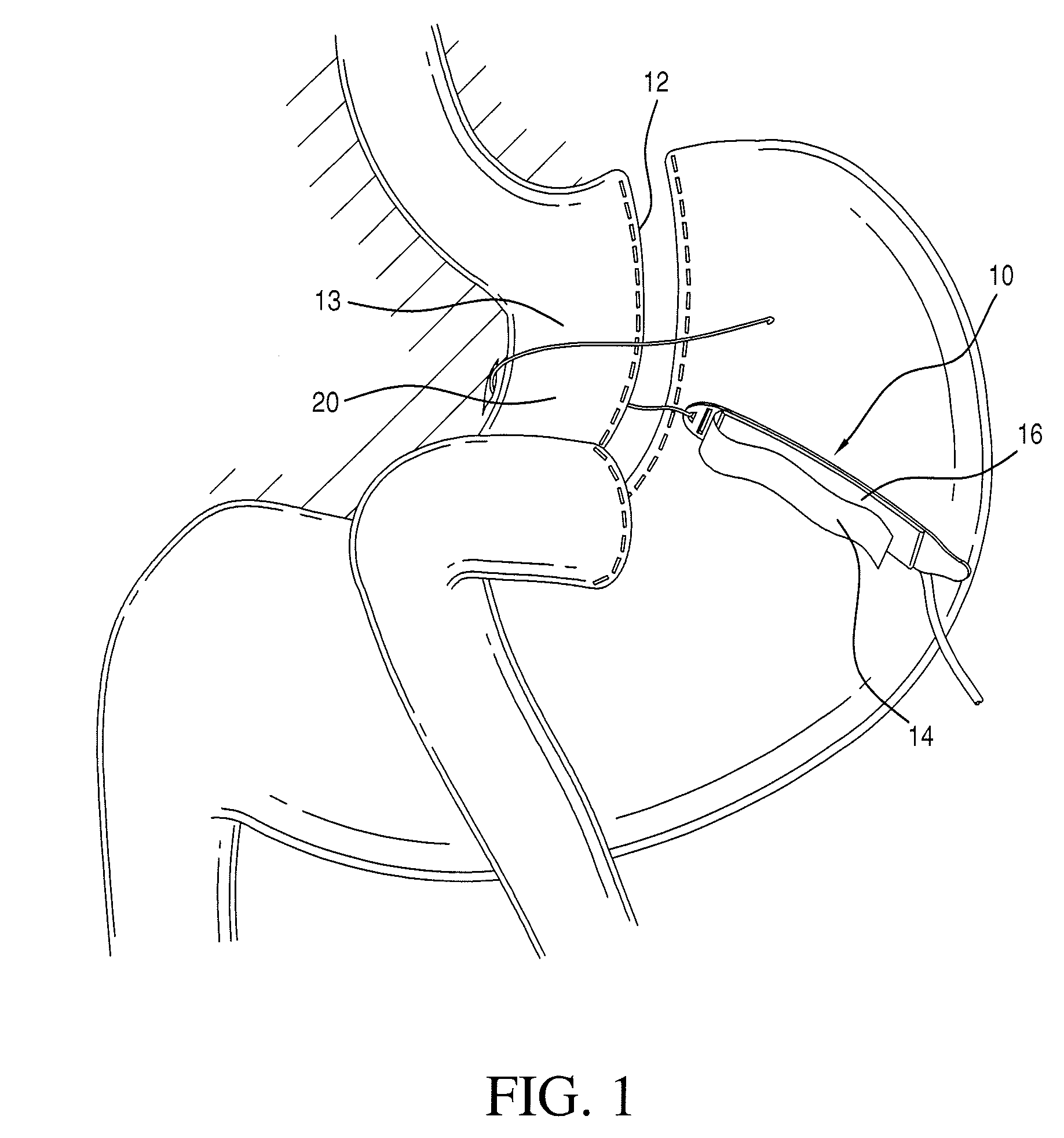 Implantable restriction device with spacer