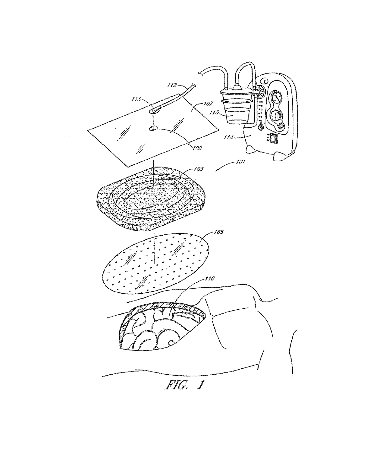 Devices and methods for treating and closing wounds with negative pressure