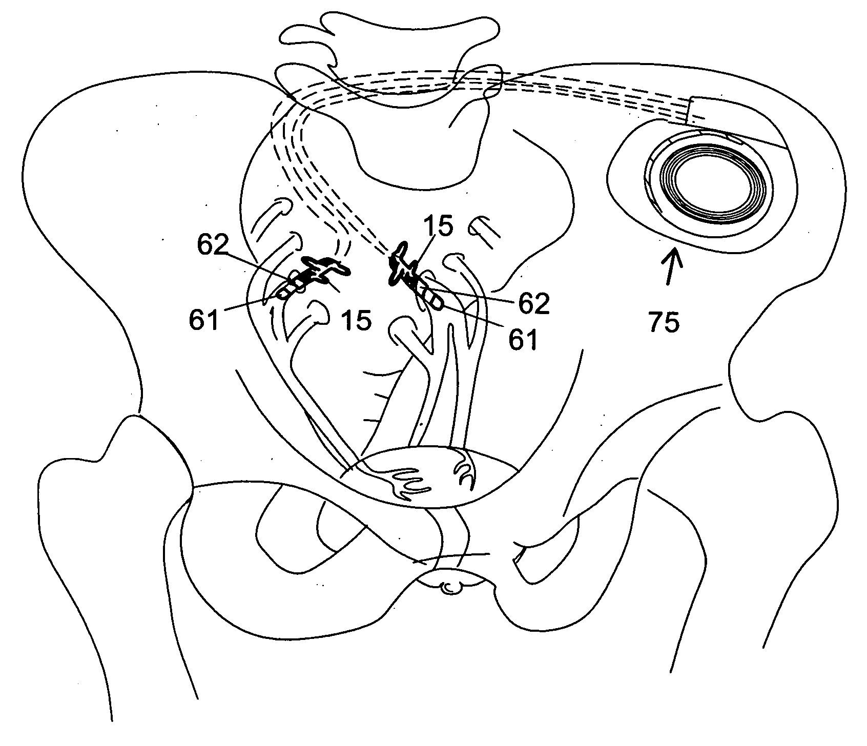Method and system for modulating sacral nerves and/or its branches in a patient to provide therapy for urological disorders and/or fecal incontinence, using rectangular and/or complex electrical pulses