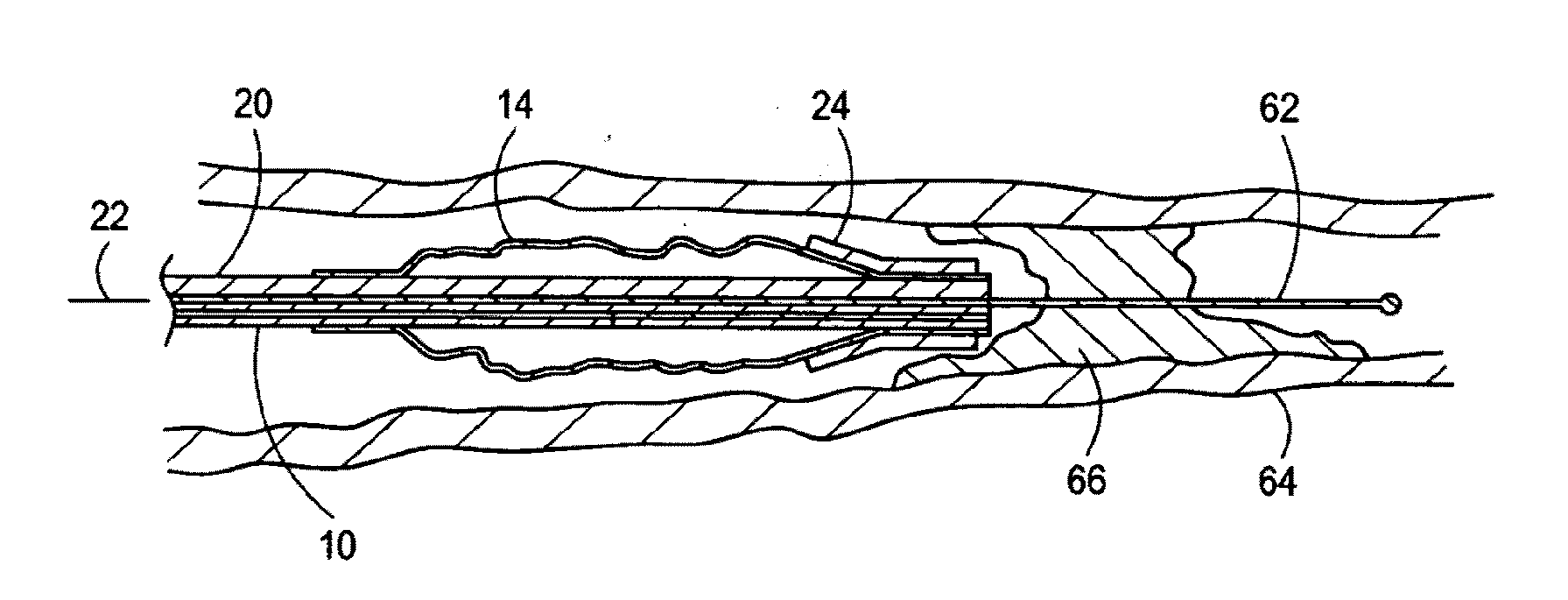 Dilatation Catheter with Enhanced Distal End for Crossing Occluded Lesions